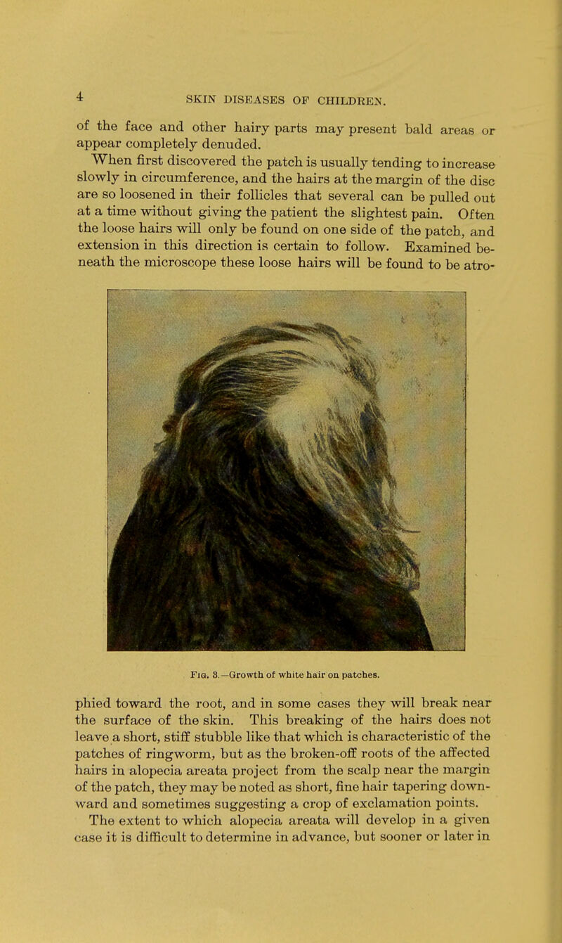 of the face and other hairy parts may present bald areas or appear completely denuded. When first discovered the patch is usually tending to increase slowly in circumference, and the hairs at the margin of the disc are so loosened in their follicles that several can be pulled out at a time without giving the patient the slightest pain. Often the loose hairs will only be found on one side of the patch, and extension in this direction is certain to follow. Examined be- neath the microscope these loose hairs will be found to be atro- Fm. 8.—Growth of white hair on patches. phied toward the root, and in some cases they will break near the surface of the skin. This breaking of the hairs does not leave a short, stiff stubble like that which is characteristic of the patches of ringworm, but as the broken-off roots of the affected hairs in alopecia areata project from the scalp near the margin of the patch, they may be noted as short, fine hair tapering down- ward and sometimes suggesting a crop of exclamation points. The extent to which alopecia areata will develop in a given case it is difficult to determine in advance, but sooner or later in