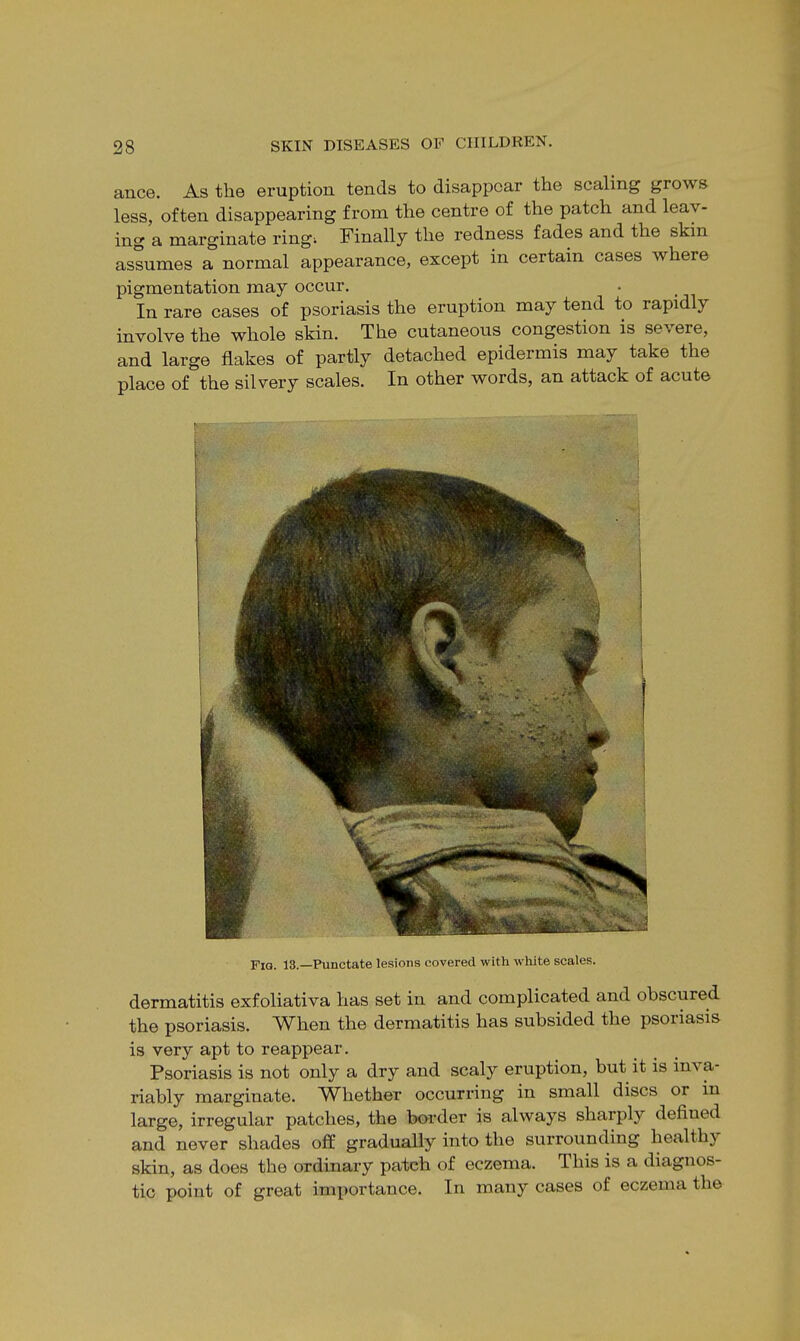 ance. As the eruption tends to disappear the scaling grows less, often disappearing from the centre of the patch and leav- ing a marginate ring; Finally the redness fades and the skin assumes a normal appearance, except in certain cases where pigmentation may occur. In rare cases of psoriasis the eruption may tend to rapidly involve the whole skin. The cutaneous congestion is severe, and large flakes of partly detached epidermis may take the place of the silvery scales. In other words, an attack of acute Fia. 13.—Punctate lesions covered with white scales. dermatitis exfoliativa has set in and complicated and obscured the psoriasis. When the dermatitis has subsided the psoriasis is very apt to reappear. Psoriasis is not only a dry and scaly eruption, but it is inva- riably marginate. Whether occurring in small discs or in large, irregular patches, the border is always sharply defiued and never shades off gradually into the surrounding healthy skin, as does the ordinary pateh of eczema. This is a diagnos- tic point of great importance. In many cases of eczema the