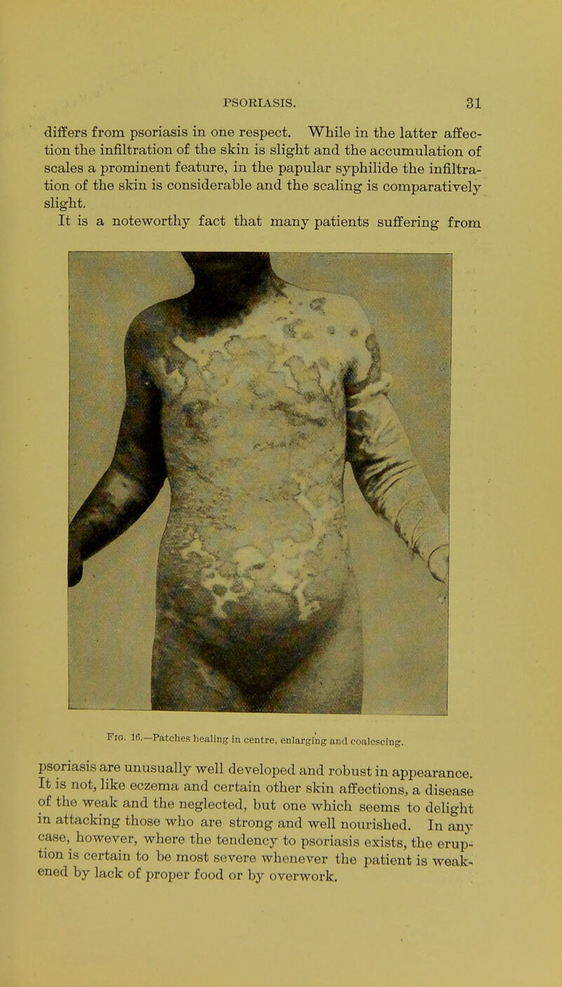 differs from psoriasis in one respect. While in the latter affec- tion the infiltration of the skin is slight and the accumulation of scales a prominent feature, in the papular syphilide the infiltra- tion of the skin is considerable and the scaling is comparatively- slight. It is a noteworthy fact that many patients suffering from Fro. 1C—Patches healing in centre, enlarging and coalescing. psoriasis are unusually well developed and robust in appearance. It is not, like eczema and certain other skin affections, a disease of the weak and the neglected, but one which seems to delight in attacking those who are strong and well nourished. In any case^ however, where the tendency to psoriasis exists, the erup- tion is certain to be most severe whenever the patient is weak- ened by lack of proper food or by overwork.