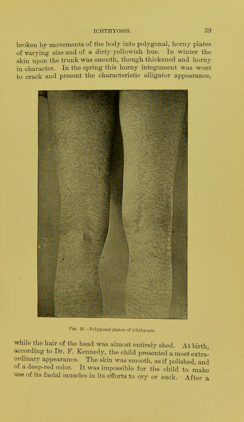 broken by movements of the body into polygonal, horny plates of varying size and of a dirty-yellowish hue. In winter the skin upon the trunk was smooth, though thickened and horny in character. In the spring this horny integument was wont to crack and present the characteristic alligator appearance, Fio 20. -Polygonal plates of ichthyosis. while the hair of the head was almost entirely shed. At birth according to Dr. F. Kennedy, the child presented a most extra- ordinary appearance. The skin was smooth, as if polished, and of a deep-red color. It was impossible for the child to make use of its facial muscles in its efforts to cry or suck. After a