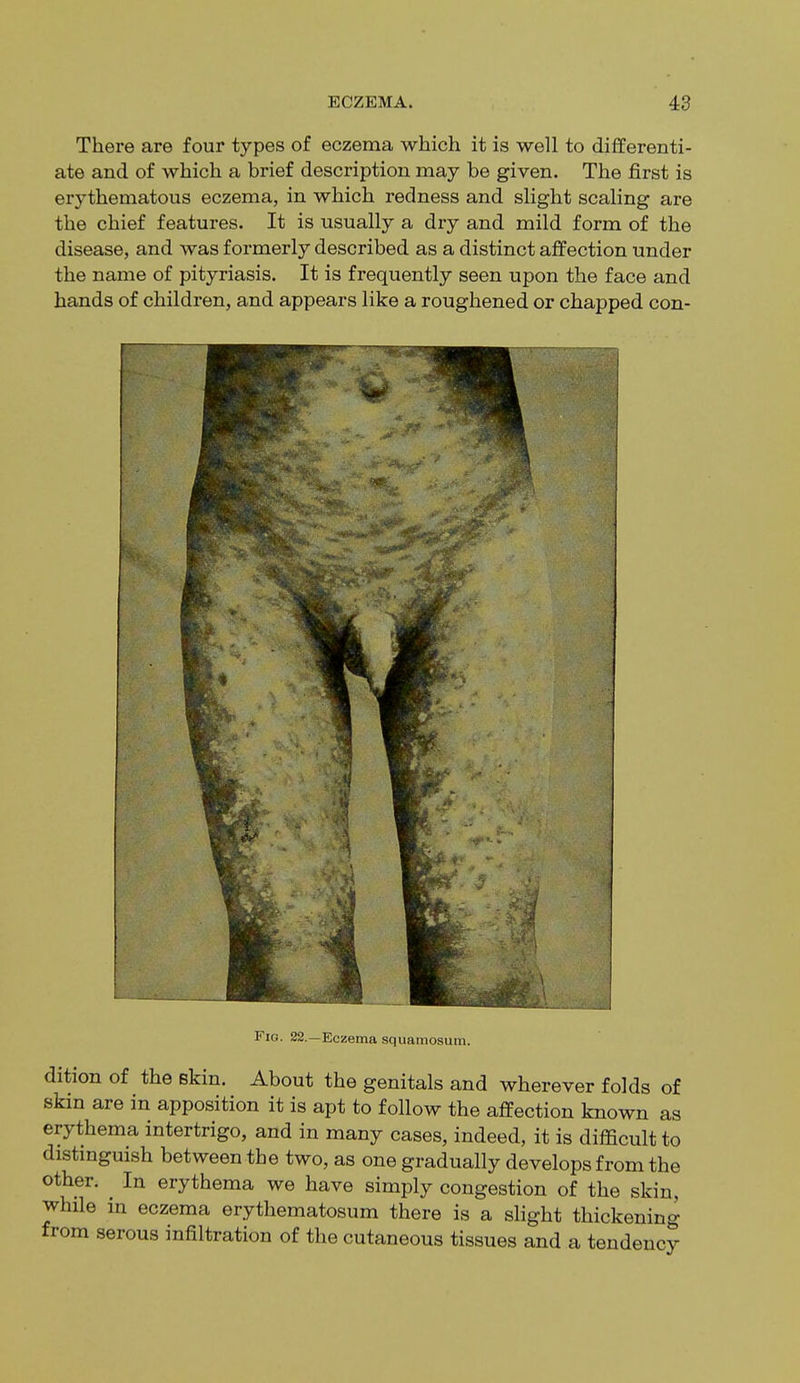 There are four types of eczema which it is well to differenti- ate and of which a brief description may be given. The first is erythematous eczema, in which redness and slight scaling are the chief features. It is usually a dry and mild form of the disease, and was formerly described as a distinct affection under the name of pityriasis. It is frequently seen upon the face and hands of children, and appears like a roughened or chapped con- Fig. 22.—Eczema squamosum. dition of the Bkin. About the genitals and wherever folds of skin are in apposition it is apt to follow the affection known as erythema intertrigo, and in many cases, indeed, it is difficult to distinguish between the two, as one gradually develops from the other. ^ In erythema we have simply congestion of the skin, while in eczema erythematosum there is a slight thickening from serous infiltration of the cutaneous tissues and a tendency