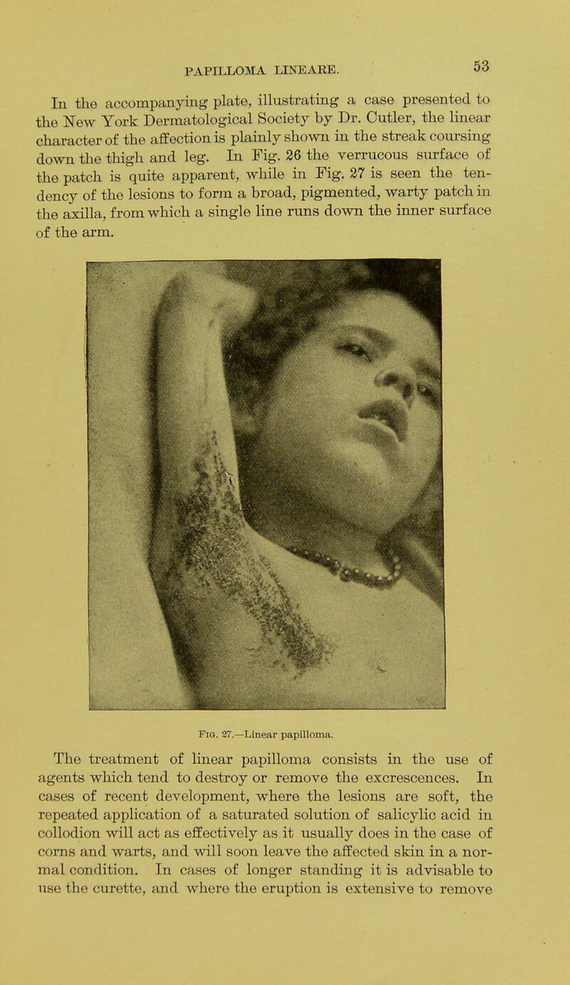 In the accompanying plate, illustrating a case presented to the New York Dermatological Society by Dr. Cutler, the linear character of the affection is plainly shown in the streak coursing down the thigh and leg. In Fig. 26 the verrucous surface of the patch is quite apparent, while in Fig. 27 is seen the ten- dency of the lesions to form a broad, pigmented, warty patch in the axilla, from which a single line runs down the inner surface of the arm. Fig. 27.—Linear papilloma. The treatment of linear papilloma consists in the use of agents which tend to destroy or remove the excrescences. In cases of recent development, where the lesions are soft, the repeated application of a saturated solution of salicylic acid in collodion will act as effectively as it usually does in the case of corns and warts, and will soon leave the affected skin in a nor- mal condition. In cases of longer standing it is advisable to use the curette, and where the eruption is extensive to remove