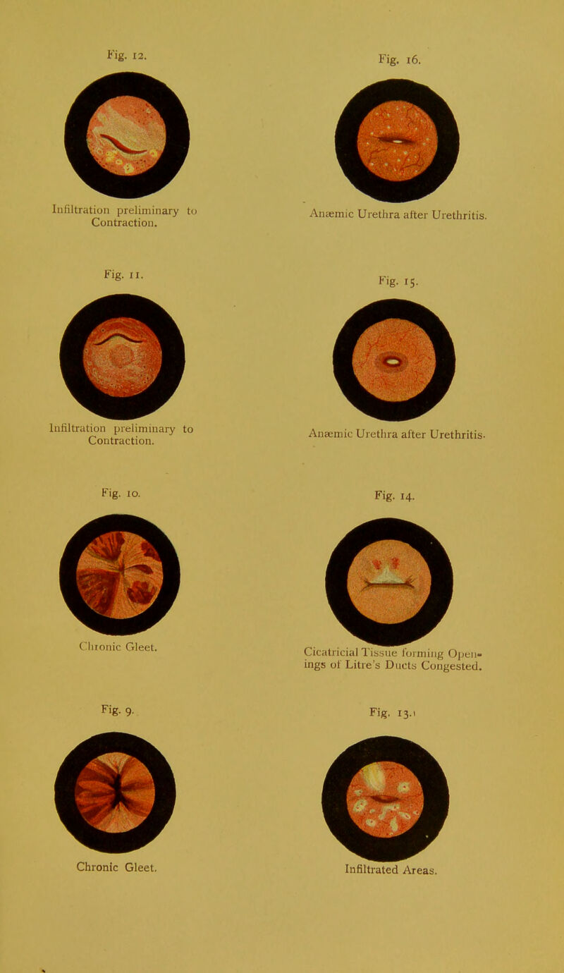 Infiltration preliminary to Contraction. Fig, 16. AnEemic Urethra alter Urethritis. Fig. II. Infiltration prelimuiary to Contraction. Fig. 15. Anaemic Urethra after Urethritis- Fig. lo. Chronic Gleet. Fig. 14. Cicatricial Tissue loi niing Open- ings ot Litre's Ducts Congested. Fig. 13.1 Infiltrated Areas.