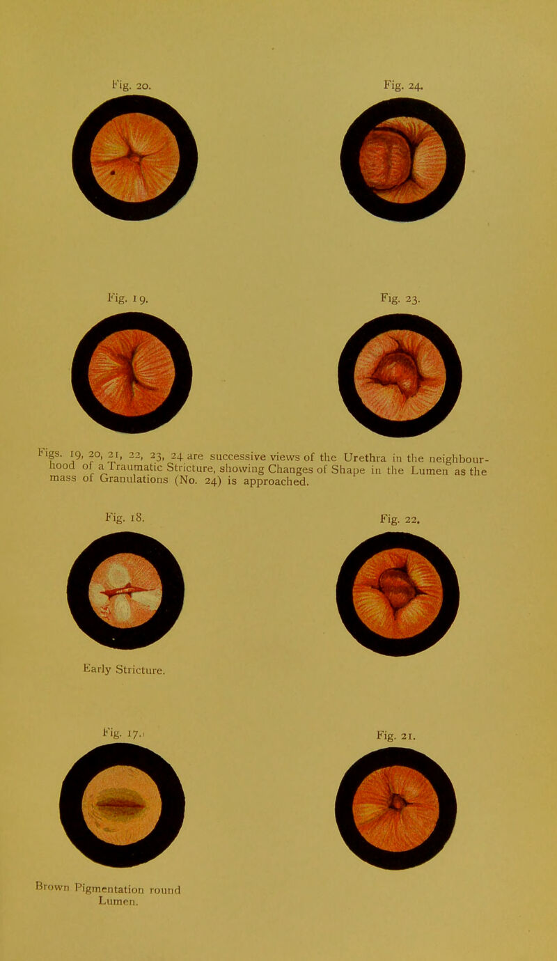 Fig. 19. Fig. 23. tigs. 19, 20, 21, 22, 23, 24 are successive views of the Urethra in tlie neighboui hood of a Traumatic Stricture, showing Changes of Shape in the Lumen as th mass ot Granulations (No. 24) is approached. ur- e Fig. 18. Fig. 22. Early Stricture. Fig. i7.> Fig. 21. Brown Pigmentation round Lumen.