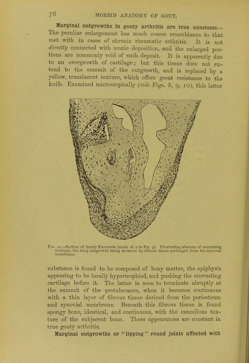 Marginal outgrowths In gouty arthritis are true exostoses— The peculiar enlargement has much coarse resemblance to that met with in cases of chronic rheumatic arthritis. It is not directly connected with uratic deposition, and the enlarged por- tions are commonly void of such deposit. It is apparently due to an overgrowth of cartilage; but this tissue does not ex- tend to the summit of the outgrowth, and is replaced by a yellow, translucent texture, which offers great resistance to the knife. Examined microscopically {vide Figs. 8, 9, 10), this latter Fio. 10.—Section of Gouty Exostosis (made at x in Fig. 9). Illustrating absence of encrusting cartilage, the bony outgrowth being invested by fibrous tissue prolonged from the eynovial membrane. substance is found to be composed of bony matter, the epiphysis appearing to be locally hypertrophied, and pushing the encrusting cartilage before it. The latter is seen to terminate abruptly at the summit of the protuberance, when it becomes continuous with a thin layer of fibrous tissue derived from the periosteum and synovial membrane. Beneath this fibrous tissue is found spongy bone, identical, and continuous, with the cancellous tex- ture of the subjacent bone. These appearances are constant in true gouty arthritis. Marginal outgrowths or lipping round joints affected with