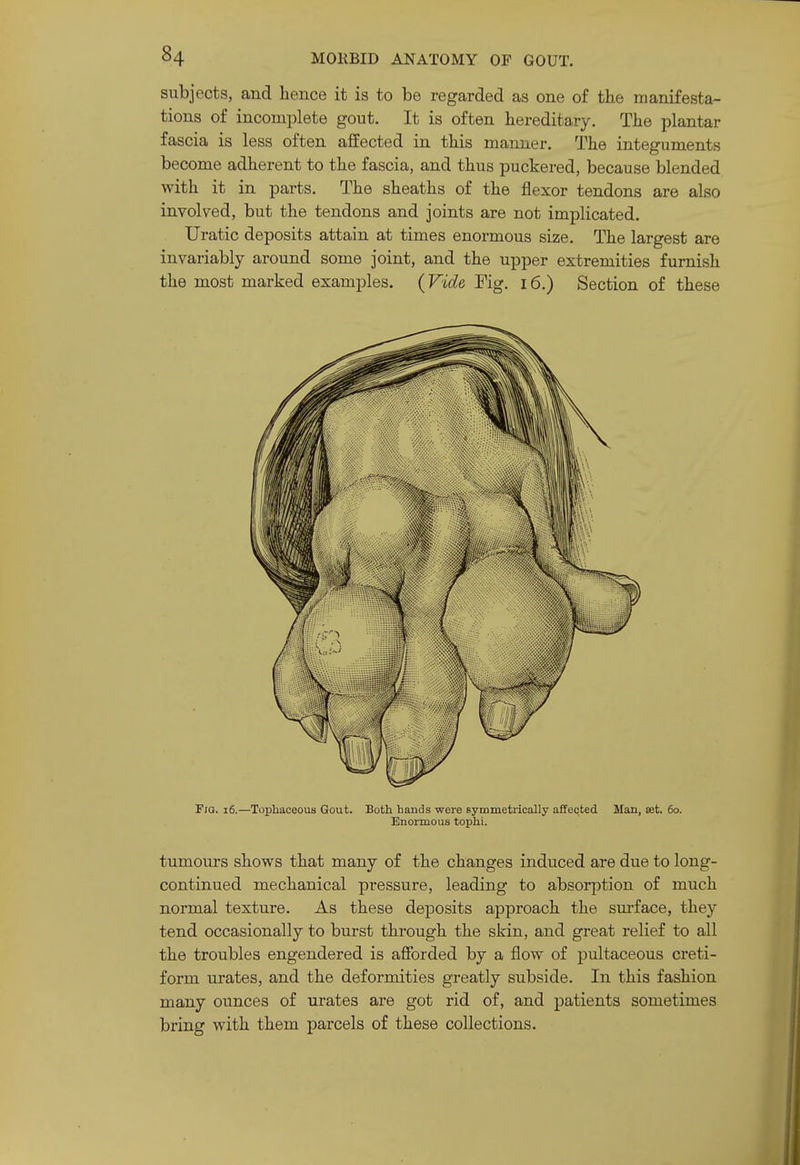 subjects, and hence it is to be regarded as one of the manifesta- tions of incomplete gout. It is often hereditary. The plantar fascia is less often affected in this manner. The integuments become adherent to the fascia, and thus puckered, because blended with it in parts. The sheaths of the flexor tendons are also involved, but the tendons and joints are not implicated. Uratic deposits attain at times enormous size. The largest are invariably around some joint, and the upper extremities furnish the most marked examples. (Vide Fig. i6.) Section of these F/G. i6.—Tophaceous Gout. Both hands were symmetrically affected Man, set. 60. Enormous tophi. tumours shows that many of the changes induced are due to long- continued mechanical pressure, leading to absorption of much normal texture. As these deposits approach the sui-face, they tend occasionally to burst through the skin, and great relief to all the troubles engendered is afforded by a flow of pultaceous creti- form urates, and the deformities greatly subside. In this fashion many ounces of urates are got rid of, and patients sometimes bring with them parcels of these collections.