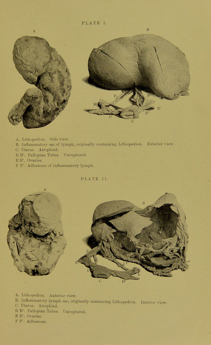 PLATE I. A. Lithopedion. Side view. B. Inflammatory sac of lymph, originally containing Lithopedion. Exterior view. C. Uterus. Atrophied. D D'. Fallopian Tubes. Unruptured. EE'. Ovaries. F F'. Adhesions of inflammatory lymph. PLATE II. A D' A. Lithopedion. Anterior view. B. Inflammatory lymph Bac, originally containing Lithopediou. Interior view. ('. Uterus. Atrophied. DC Fallopian Tubes. Qnruptured. E E'. Ovaries. F F'. Adhesions.