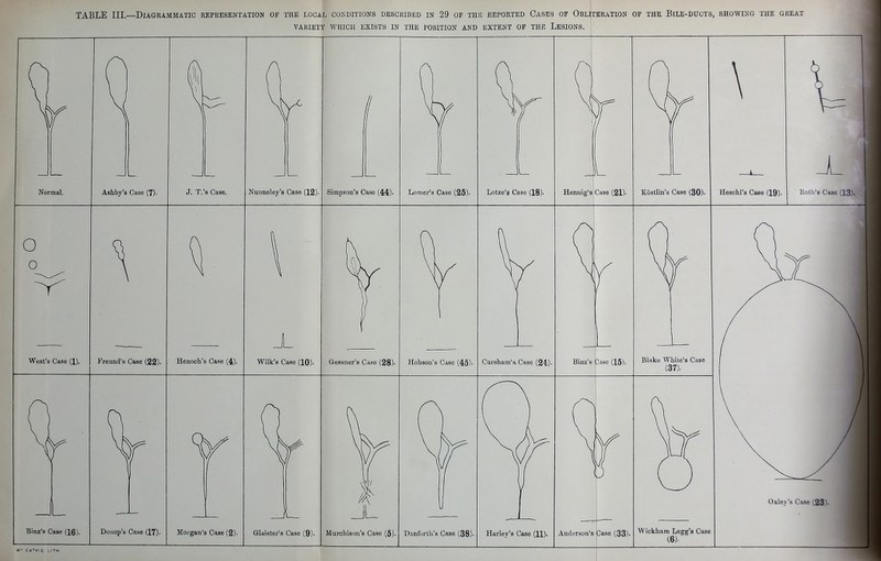 TABLE III.—DiAGKAMMATIC REPRESENTATION OF THE LOCAL CONDITIONS DESCRIBED IN 29 OF THB REPORTED CaSES OF OBLITERATION OF THE BiLE-DUCTS, SHOWING THE GREAT VARIETY WHICH EXISTS IN THE POSITION AND EXTENT OF THE LESIONS. Normal. Ashby's Case (7). J. T.'s Case. Nunneley's Case (12). Simpson's Case (44)- Lomer's Case (25)- Lotze's Case (18). Hennig's Case (21). Kostlin's Case (30). o o West's Case (1). Freund's Case (22)- Binz'a Case (16). Doiiop's Case (17). ± Henoch's Case (4). Wilk's Case (10). Gessner'KS Case (28)- Hobson's Case (45)- Cursham's Case (24)- Binz's 3ase (15). Morgan's Case (2)- Blake White's Case (37). Glaister's Case (9)- Murohison's Case (5). Danfdi-th's Case (38). Harley's Case (H). Anderson's Case (33) W CATH'E LITH Wickham Legg's Case (6).