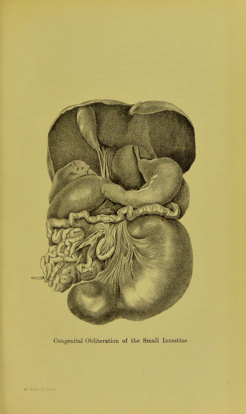Congenital Obliteration of the Small Intestine