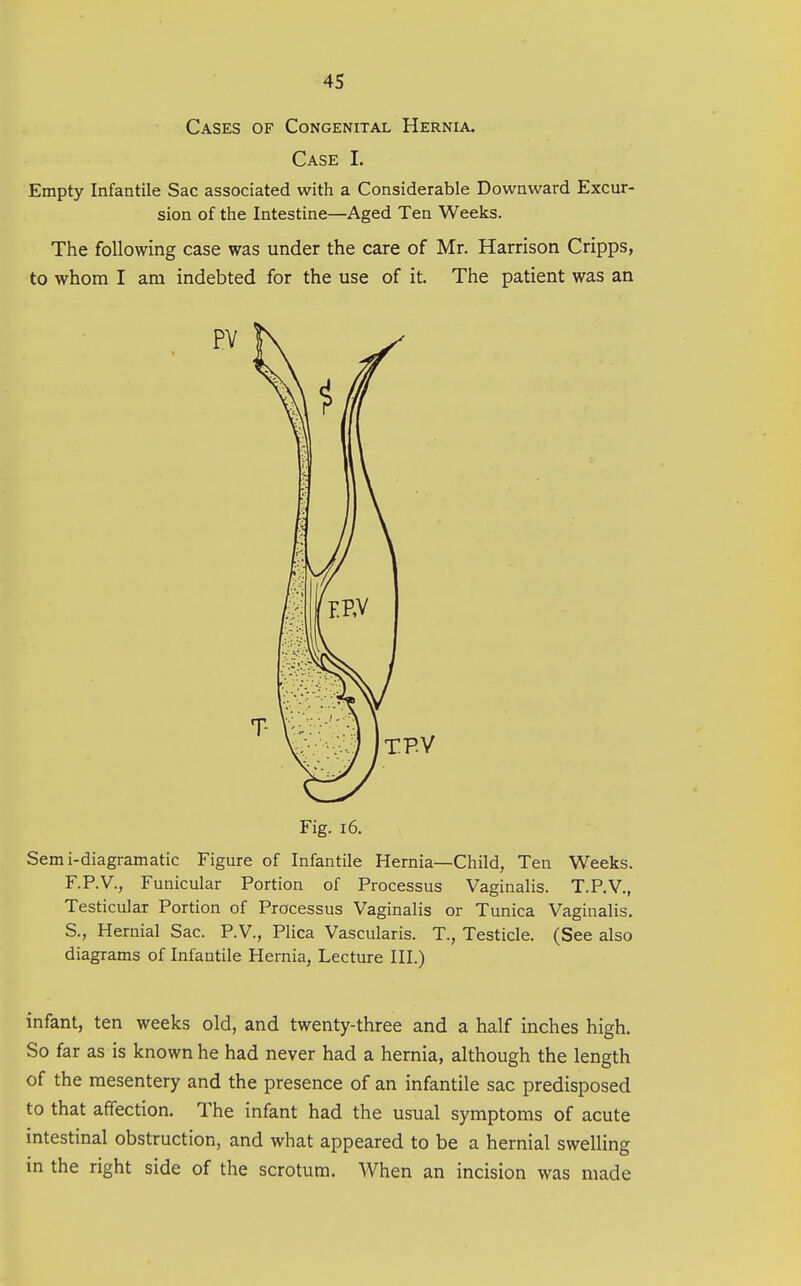 Cases of Congenital Hernia. Case I. Empty Infantile Sac associated with a Considerable Downward Excur- sion of the Intestine—Aged Ten Weeks. The following case was under the care of Mr, Harrison Cripps, to whom I am indebted for the use of it. The patient was an PV Fig. 16. Sem i-diagramatic Figure of Infantile Hernia—Child, Ten Weeks. F.P.V., Funicular Portion of Processus Vaginalis. T.P.V., Testicular Portion of Processus Vaginalis or Tunica Vaginalis. S., Hernial Sac. P.V., Plica Vascularis. T., Testicle. (See also diagrams of Infantile Hernia, Lecture III.) infant, ten weeks old, and twenty-three and a half inches high. So far as is known he had never had a hernia, although the length of the mesentery and the presence of an infantile sac predisposed to that affection. The infant had the usual symptoms of acute intestinal obstruction, and what appeared to be a hernial swelling in the right side of the scrotum. When an incision was made