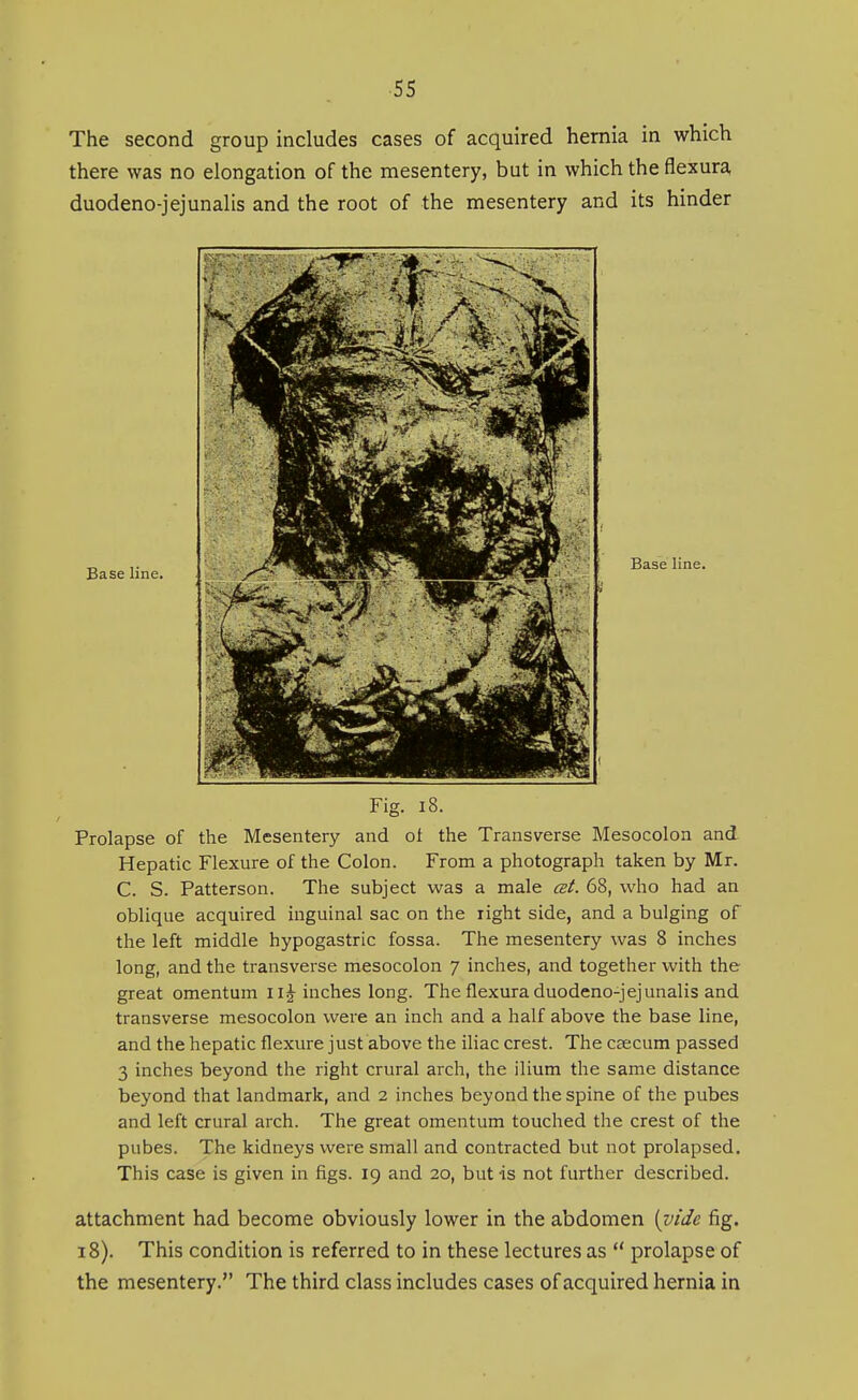 The second group includes cases of acquired hernia in which there was no elongation of the mesentery, but in which the flexura duodeno-jejunalis and the root of the mesentery and its hinder Base line. Base line. Fig. 18. Prolapse of the Mesentery and of the Transverse Mesocolon and Hepatic Flexure of the Colon. From a photograph taken by Mr. C. S. Patterson. The subject was a male cBt. 68, who had an oblique acquired inguinal sac on the right side, and a bulging of the left middle hypogastric fossa. The mesentery was 8 inches long, and the transverse mesocolon 7 inches, and together with the great omentum i inches long. The flexura duodeno-jejunalis and transverse mesocolon were an inch and a half above the base line, and the hepatic flexure just above the iliac crest. The caecum passed 3 inches beyond the right crural arch, the ilium the same distance beyond that landmark, and 2 inches beyond the spine of the pubes and left crural arch. The great omentum touched the crest of the pubes. The kidneys were small and contracted but not prolapsed. This case is given in figs. 19 and 20, but is not further described. attachment had become obviously lower in the abdomen [vide fig. 18). This condition is referred to in these lectures as  prolapse of the mesentery. The third class includes cases of acquired hernia in