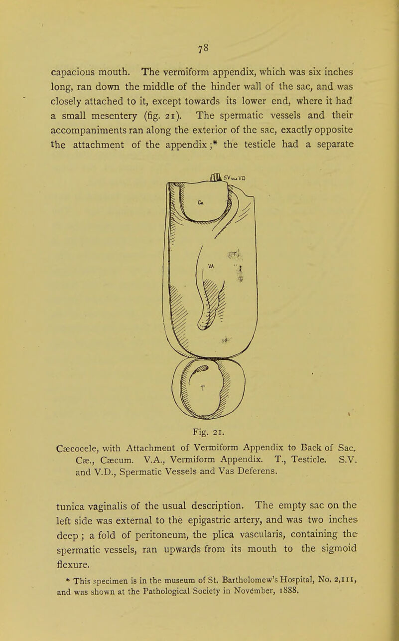 capacious mouth. The vermiform appendix, which was six inches long, ran down the middle of the hinder wall of the sac, and was closely attached to it, except towards its lower end, where it had a small mesentery (fig. 21). The spermatic vessels and their accompaniments ran along the exterior of the sac, exactly opposite the attachment of the appendix ;* the testicle had a separate Fig. 21. CEecocele, with Attachment of Vermiform Appendix to Back of Sac. Cae., Caecum. V.A., Vermiform Appendix. T., Testicle. S.V. and V.D., Spermatic Vessels and Vas Deferens. tunica vaginaHs of the usual description. The empty sac on the left side was external to the epigastric artery, and was two inches- deep ; a fold of peritoneum, the plica vascularis, containing the spermatic vessels, ran upwards from its mouth to the sigmoid flexure. * This specimen is in the museum of St. Bartholomew's Hospital, No. 2,111, and was shown at the Pathological Society in November, 1888.