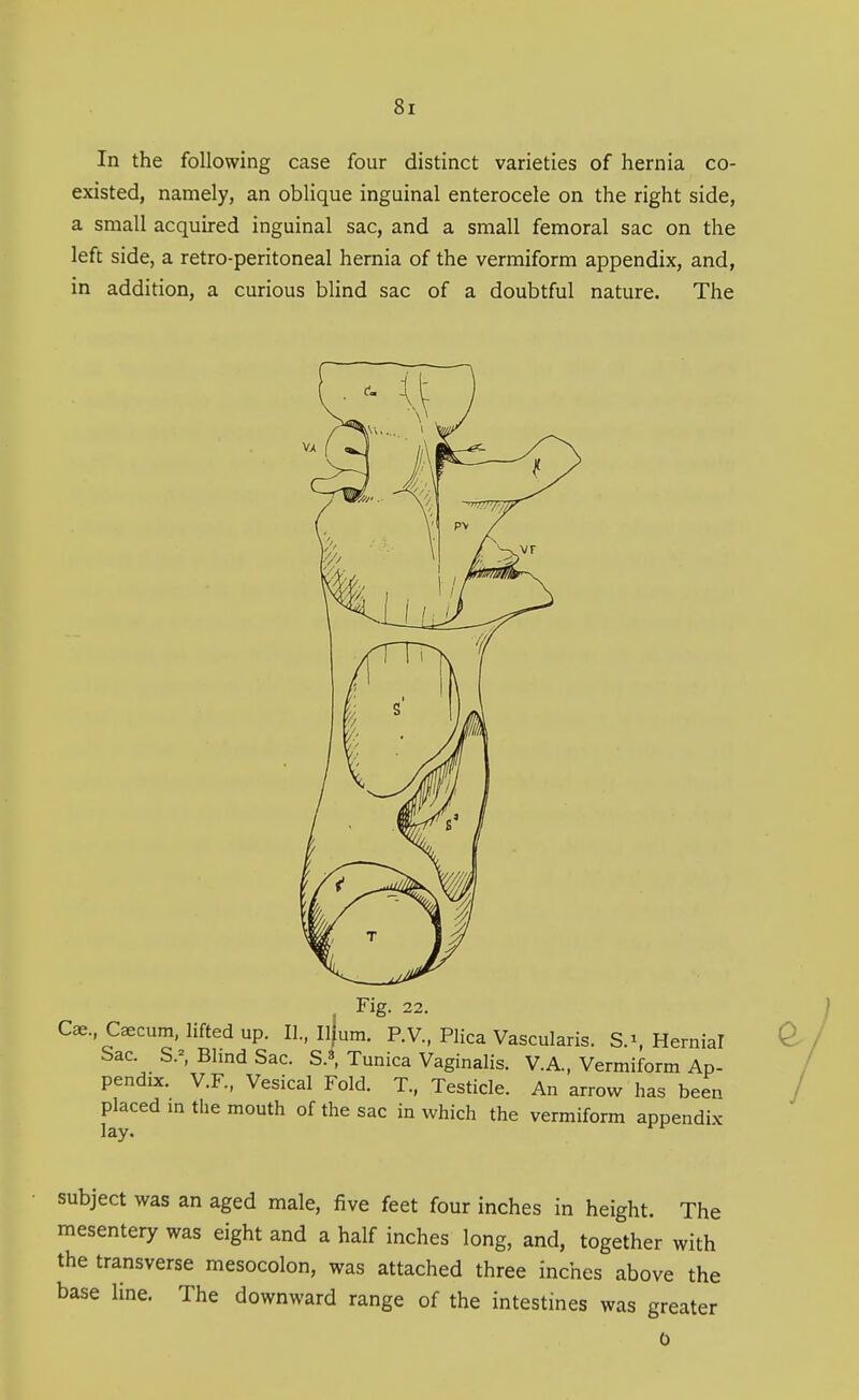 In the following case four distinct varieties of hernia co- existed, namely, an oblique inguinal enterocele on the right side, a small acquired inguinal sac, and a small femoral sac on the left side, a retro-peritoneal hernia of the vermiform appendix, and, in addition, a curious blind sac of a doubtful nature. The Fig. 22. Cae.,C^cum, lifted up. II., Iljum. P.V., Plica Vascularis. Hernial Sac. S.^ Blind Sac. S.«, Tunica Vaginalis. V.A., Vermiform Ap- pendix. V.F., Vesical Fold. T., Testicle. An arrow has been placed m the mouth of the sac in which the vermiform appendix lay. subject was an aged male, five feet four inches in height. The mesentery was eight and a half inches long, and, together with the transverse mesocolon, was attached three inches above the base line. The downward range of the intestines was greater
