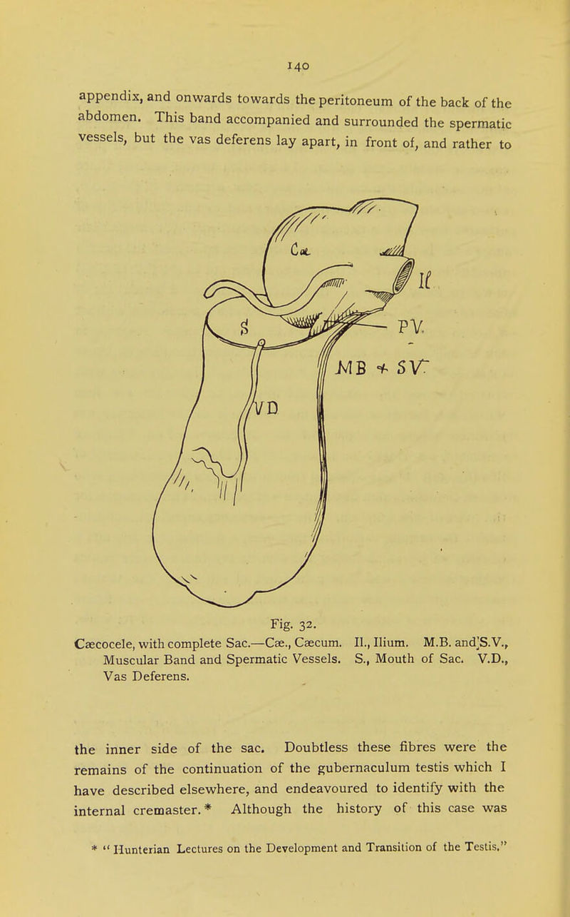 appendix, and onwards towards the peritoneum of the back of the abdomen. This band accompanied and surrounded the spermatic vessels, but the vas deferens lay apart, in front of, and rather to Fig. 32. Caecocele, with complete Sac.—Cae., Caecum. II., Ilium. M.B. and'S.V., Muscular Band and Spermatic Vessels. S., Mouth of Sac. V.D., Vas Deferens. the inner side of the sac. Doubtless these fibres were the remains of the continuation of the gubernaculum testis which I have described elsewhere, and endeavoured to identify with the internal crenaaster. * Although the history of this case was *  Hunterian Lectures on the Development and Transition of the Testis.