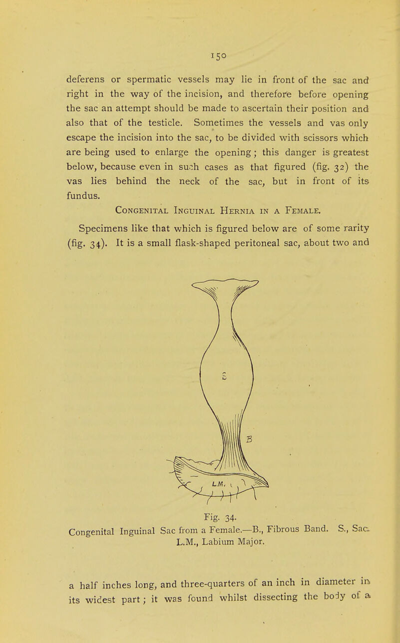 15° deferens or spermatic vessels may lie in front of the sac and right in the way of the incision, and therefore before opening the sac an attempt should be made to ascertain their position and also that of the testicle. Sometimes the vessels and vas only escape the incision into the sac, to be divided with scissors which are being used to enlarge the opening; this danger is greatest below, because even in such cases as that figured (fig. 32) the vas lies behind the neck of the sac, but in front of its fundus. Congenital Inguinal Hernia in a Female. Specimens like that which is figured below are of some rarity (fig. 34.). It is a small flask-shaped peritoneal sac, about two and Fig. 34- Congenital Inguinal Sac from a Female.—B., Fibrous Band. S., Saa L.M., Labium Major. a half inches long, and three-quarters of an inch in diameter in. its widest part; it was found whilst dissecting the body of a