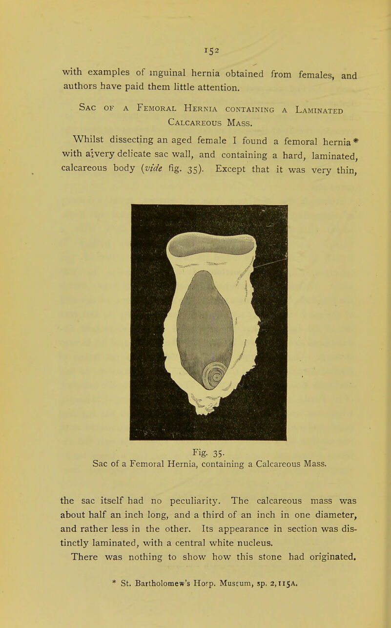 with examples of inguinal hernia obtained from females, and authors have paid them Httle attention. Sac of a Femoral Hernia containing a Laminated Calcareous Mass, Whilst dissecting an aged female I found a femoral hernia* with aivery delicate sac wall, and containing a hard, laminated, calcareous body {vide fig. 35). Except that it was very thin, Fig. 35. Sac of a Femoral Hernia, containing a Calcareous Mass. the sac itself had no peculiarity. The calcareous mass was about half an inch long, and a third of an inch in one diameter, and rather less in the other. Its appearance in section was dis- tinctly laminated, with a central white nucleus. There was nothing to show how this stone had originated. * St. Bartholomew's Horp. Museum, sp. 2, H5A.