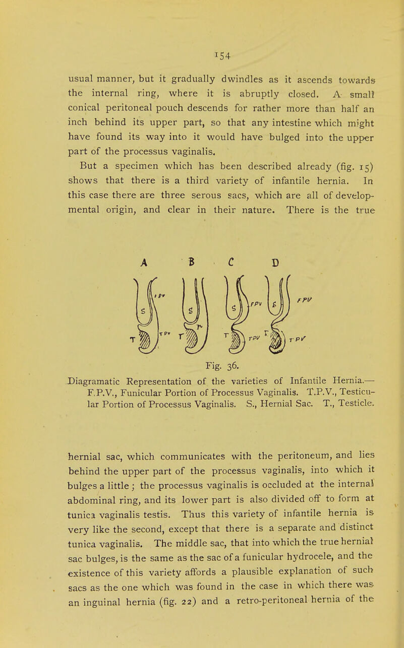 usual manner, but it gradually dwindles as it ascends towards the internal ring, where it is abruptly closed. A small conical peritoneal pouch descends for rather more than half an inch behind its upper part, so that any intestine which might have found its way into it would have bulged into the upper part of the processus vaginalis. But a specimen which has been described already (fig, 15) shows that there is a third variety of infantile hernia. In this case there are three serous sacs, which are all of develop- mental origin, and clear in their nature. There is the true A B C D Fig. 36. Diagramatic Representation of the varieties of Infantile Hernia.— F.P.V., Funicular Portion of Processus Vaginalis. T.P.V., Testicu- lar Portion of Processus Vaginalis. S., Hernial Sac. T., Testicle. hernial sac, which communicates with the peritoneum, and lies behind the upper part of the processus vaginalis, into which it bulges a little ; the processus vaginalis is occluded at the internal abdominal ring, and its lower part is also divided off to form at tunica vaginalis testis. Thus this variety of infantile hernia is very like the second, except that there is a separate and distinct tunica vaginalis. The middle sac, that into which the true hernial sac bulges, is the same as the sac of a funicular hydrocele, and the existence of this variety affords a plausible explanation of sucl> sacs as the one which was found in the case in which there was an inguinal hernia (fig. 22) and a retro-peritoneal hernia of the