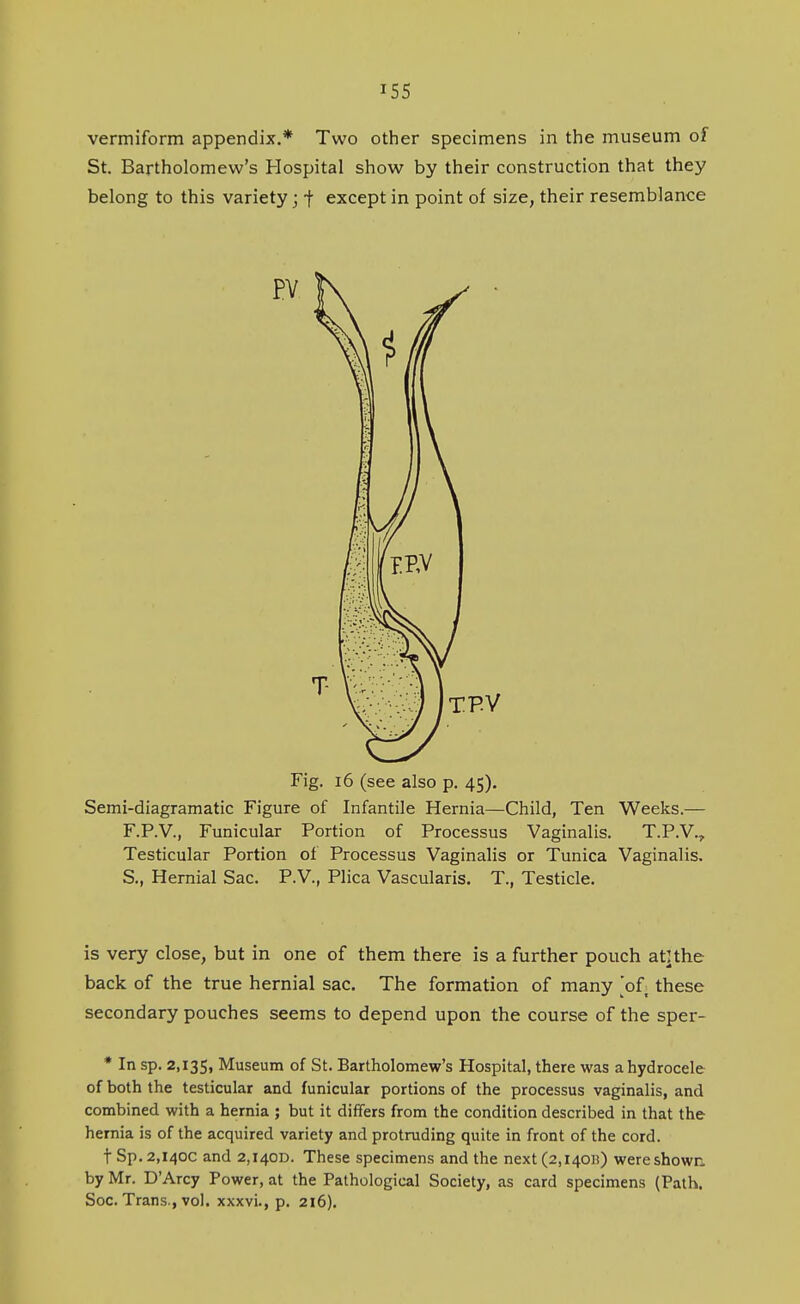 vermiform appendix.* Two other specimens in the museum of St. Bartholomew's Hospital show by their construction that they belong to this variety; -f except in point of size, their resemblance Fig. i6 (see also p. 45), Semi-diagramatic Figure of Infantile Hernia—Child, Ten Weeks.— F.P.V., Funicular Portion of Processus Vaginalis. T.P.V., Testicular Portion of Processus Vaginalis or Tunica Vaginalis. S,, Hernial Sac. P.V., Plica Vascularis. T., Testicle. is very close, but in one of them there is a further pouch atlthe back of the true hernial sac. The formation of many 'of these secondary pouches seems to depend upon the course of the sper- * In sp. 2,135, Museum of St. Bartholomew's Hospital, there was a hydrocele of both the testicular and funicular portions of the processus vaginalis, and combined with a hernia ; but it differs from the condition described in that the hernia is of the acquired variety and protruding quite in front of the cord. tSp. 2,140c and 2,i40D. These specimens and the next(2,i4on) were shown, by Mr. D'Arcy Power, at the Pathological Society, as card specimens (Path, Soc. Trans , vol. xxxvi., p. 216),