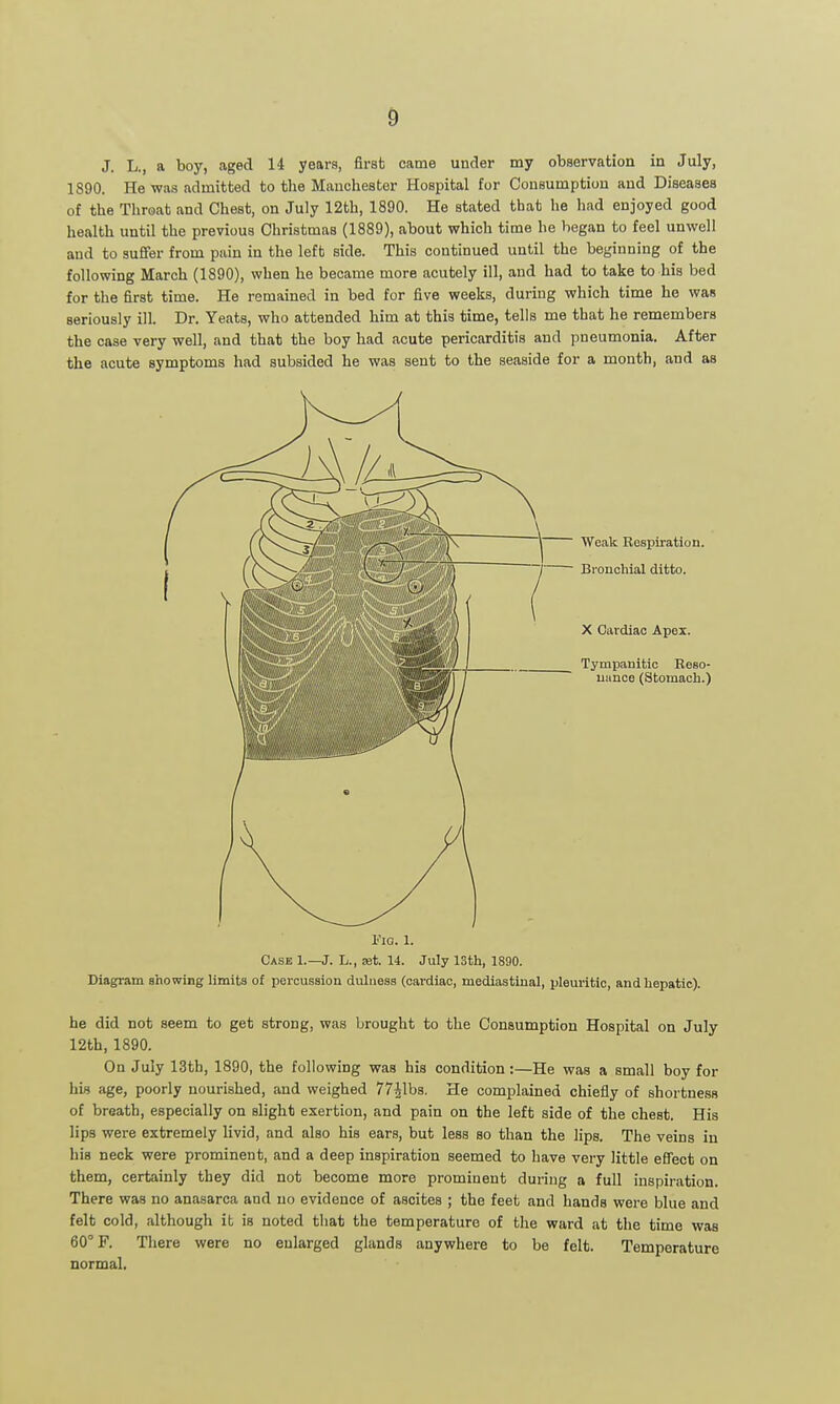 J. L., a boy, aged 14 years, first came under my observation in July, 1890. He was admitted to the Manchester Hospital for Consumption and Diseases of the Throat and Chest, on July 12th, 1890. He stated that he had enjoyed good health until the previous Christmas (1889), about which time he began to feel unwell and to sufifer from pain in the left side. This continued until the beginning of the following March (1890), when he became more acutely ill, and had to take to his bed for the first time. He remained in bed for five weeks, during which time he was seriously ill. Dr. Yeats, who attended him at this time, tells me that he remembers the case very well, and that the boy had acute pericarditis and pneumonia. After the acute symptoms had subsided he was sent to the seaside for a month, and as Weak Eespiration. Bronchial ditto. X Cardiac Apex. Tympanitic Reso- uance (Stomach.) l''io. 1. Case 1.—J. L., set. 14. July 13th, 1890. Diagram showing limits of percussion duluess (cardiac, mediastinal, pleuritic, and hepatic). he did not seem to get strong, was brought to the Consumption Hospital on July 12th, 1890. On July 13th, 1890, the following was his condition:—He was a small boy for his age, poorly nourished, and weighed 77ilbs. He complained chiefly of shortness of breath, especially on slight exertion, and pain on the left side of the chest. His lips were extremely livid, and also his ears, but less so than the lips. The veins in his neck were prominent, and a deep inspiration seemed to have very little effect on them, certainly they did not become more prominent during a full inspiration. There was no anasarca and no evidence of ascites ; the feet and hands were blue and felt cold, although it is noted that the temperature of the ward at the time was 60° F. There were no enlarged glands anywhere to be felt. Temperature normal.