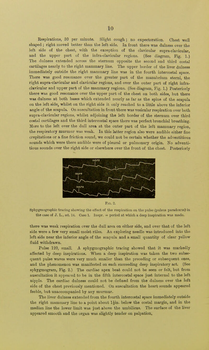 Respirations, 30 per minute. Slight cough; no expectoration. Chest well shaped ; right moved better than the left side. In front there was dulness over the left side of the chest, with the exception of the clavicular supra-clavicular, and the upper part of the infra-clavicular regions. (See diagram, Fig. 1.) The dulness extended across the sternum opposite the second and third costal cartilages nearly to the right mammary line. The upper border of the liver dulness immediately outside the right mammary line was in the fourth intercostal space. There was good resonance over the greater part of the manubrium stemi, the right supra-clavicular and clavicular regions, and over the outer part of right infra- clavicular and upper part of the mammary regions. (See diagram, Fig. 1.) Posteriorly there was good resonance over the upper part of the chest on both sides, but there was dulness at both bases which extended nearly as far as the spine of the scapula on the left side, whilst on the right side it only reached to a little above the inferior angle of the scapula. On auscultation in front there was vesicular respiration over both supra-clavicular regions, whilst adjoining the left border of the sternum over third costal cartilages and the third intercostal space there was perfect bronchial breathing. More to the left over the dull area at the outer part of the left mammary region, the respiratory murmur was weak. In this latter region also were audible either fine crepitations or a flue friction sound, we could not be certain whether the adventitious sounds which were there audible were of pleural or pulmonary origin. No adventi- tious sounds over the right side or elsewhere over the front of the chest. Posteriorly INSPR I Fig. 2. Sphygmographic tracing showing the effect of the respiration on the pulse (pulsus paradoxus) in the case of J. L., set. 14. Case 1. Inspr, = period at which a deep inspiration was made. there was weak respiration over the dull area on either side, and over that of the left side were a few very small moist rfiles. An exploring needle was introduced into the left side near the inferior angle of the scapula and a small quantity of clear yellow fluid withdrawn. Pulse 120, small. A sphygmographic tracing showed that it was markedly aflfected by deep inspirations. When a deep inspiration was taken the two subse- quent pulse waves were very much smaller than the preceding or subsequent ones, and the phenomenon was manifested on each succeeding deep inspiratory act. (See sphygmogram, Fig. 2.) The cardiac apex beat could not be seen or felt, but from auscultation it appeared to be in the fifth intercostal space just internal to the left nipple. The cardiac dulness could not be defined from the dulness over the left side of the chest previously mentioned. On auscultation the heart sounds appeared feeble, bub unaccompanied by any murmur. The liver dulness extended from the fourth intercostal space immediately outside the right mammary line to a point about l^in. below the costal margin, and in the median line the lower limit was just above the umbilicus. The surface of the liver appeared smooth and the organ was slightly tender on palpation.