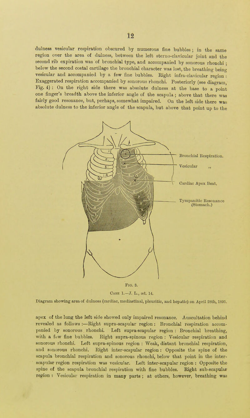 1^ dulness vesicular respiration obscured by numerous fine bubbles; in the same region over the area of dulness, between the left sterno-clavicular joint and the second rib expiration was of bronchial type, and accompanied by sonorous rhonchi ; below the second costal cartilage the bronchial character was lost, the breathing being vesicular and accompanied by a few fine bubbles. Right infra-clavicular region : Exaggerated respiration accompanied by sonorous rhonchi. Posteriorly (see diagram, Fig. 4) : On the right side there was absolute dulness at the base to a point one finger's breadth above the inferior angle of the scapula ; above that there was fairly good resonance, but, perhaps, somewhat impaired. On the left side there was absolute dulness to the inferior angle of the scapula, but above that point up to the Fio. 3. Case 1.—J. L., ajt. 14. Diagram showing area of dulness (cardiac, mediastinal, pleuritic, and hepatic) on April 28th, 1891. apex of the lung the left side showed only impaired resonance. Auscultation behind revealed as follows :—Right supra-scapular region: Bronchial respiration accom- panied by sonorous rhonchi. Left supra-scapular region : Bronchial breathing, with a few fine bubbles. Right supra-spinous region : Vesicular respiration and sonorous rhonchi. Left supra-spinous region : Weak, distant bronchial respiration, and sonorous rhonchi. Right iuter-scapular region : Opposite the spine of the scapula bronchial respiration and sonorous rhonchi, below that point in the inter- scapular region respiration was vesicular. Left inter-scapular region : Opposite the spine of the scapula bronchial respiration with fine bubbles. Right sub-scapular region : Vesicular respiration in many parts ; at others, however, breathing was