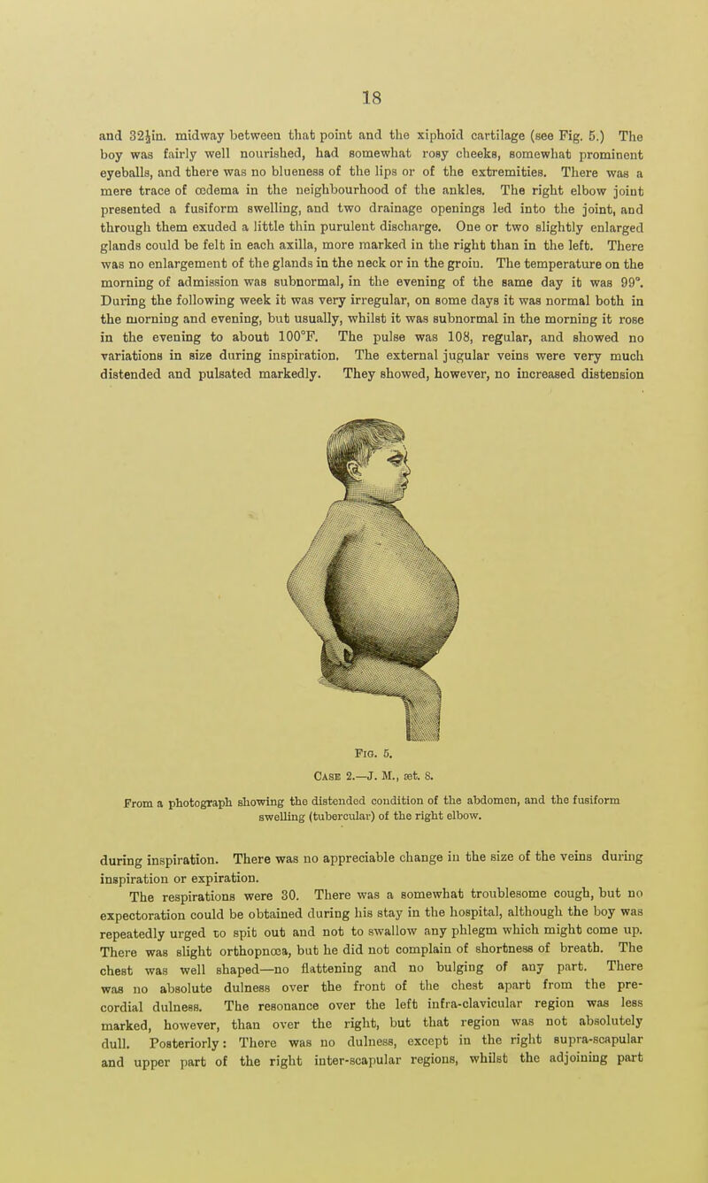 and 32^in. midway between that point and the xiphoid cartilage (see Fig. 5.) The boy was fairly well nourished, had somewhat rosy cheeks, somewhat prominent eyeballs, and there was no blueness of the lips or of the extremities. There was a mere trace of oidema in the neighbourhood of the ankles. The right elbow joint presented a fusiform swelling, and two drainage openings led into the joint, and through them exuded a little thin purulent discharge. One or two slightly enlarged glands could be felt in each axilla, more marked in the right than in the left. There was no enlargement of the glands in the neck or in the groin. The temperature on the morning of admission was subnormal, in the evening of the same day it was 99°. During the following week it was very irregular, on some days it was normal both in the morning and evening, but usually, whilst it was subnormal in the morning it rose in the evening to about 100°F. The pulse was 108, regular, and showed no variations in size during inspiration. The external jugular veins were very much distended and pulsated markedly. They showed, however, no increased distension Fio. 5. Case 2 J. M., set. S. From a photograph showing the distendod condition of the abdomen, and the fusiform swelling (tubercular) of the right elbow. during inspiration. There was no appreciable change in the size of the veins during inspiration or expiration. The respirations were 30. There was a somewhat troublesome cough, but no expectoration could be obtained during his stay in the hospital, although the boy was repeatedly urged to spit out and not to swallow any phlegm which might come up. There was slight orthopnoja, but he did not complain of shortness of breath. The chest was well shaped—no flattening and no bulging of any part. There was no absolute dulness over the front of the chest apart from the pre- cordial dulneas. The resonance over the left infra-clavicular region was less marked, however, than over the right, but that region was not absolutely dull. Posteriorly: There was no dulness, except in the right supra-scapular and upper part of the right inter-scapular regions, whilst the adjoining part