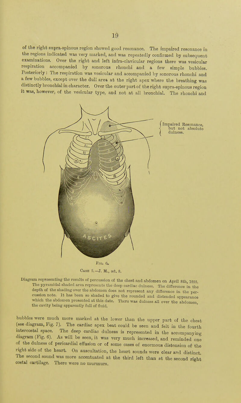 of the right supra-spiuous region showed good resonance. The impaired resonance in the regions indicated was very marked, and was repeatedly confirmed by subsequent examinations. Over the right and left infra-cJavicular regions there was vesicular respiration accompanied by sonorous rhonchi and a few simple bubbles. Posteriorly: The respiration was vesicular and accompanied by sonorous rhonchi and a few bubbles, except over the dull area at the right apex where the breathing was distinctly bronchial in character. Over the outer part of the right supra-spiuous region it was, however, of the vesicular type, and not at all bronchial. The rhonchi and Impaired Resonance, but not absolute dulness. Fig. 6. Case 2.—J. M., set, 8. Diagram representing the results of percussion of the chest and abdomen on AprU 8th, 1893. The pyramidal shaded area roprosciits the deep cardiac dulness. The difiference in the depth of the shading over the abdomen does not represent any difference in the per- cussion note. It has been so shaded to give the rounded and distended appearance which the abdomen presented at this date. There was dulness aU over the abdomen the cavity being apparently full of fluid. ' bubbles were much more marked at the lower than the upper part of the chest (see diagram, Fig. 7). The cardiac apex beat could be seen and felt in the fourth intercostal space. The deep cardiac dulness is represented in the accompanying diagram (Fig. 6). As will be seen, it was very much increased, and reminded one of the dulness of pericardial eflfusion or of some cases of enormous dist'jusion of the right side of the heart. On auscultation, the heart sounds were clear and distinct The second sound was more accentuated at the third left than at the second right costal cartilage. There were no murmurs.