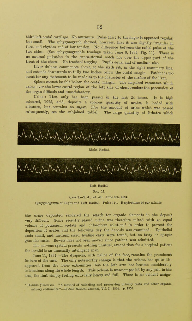 St third left costal cartilage. No murmurs. Pulse 114 ; to the finger it appeared regular but small. The spbygmograph showed, however, that it was slightly irregular in force and rhythm and of low tension. No difiference between the radial pulse of the two sides. (See sphygmographic tracings taken June 8, 1894, Fig. 11). There is no unusual pulsation in the supra-sternal notch nor over the upper part of the front of the chest. No tracheal tugging. Pupils equal and of medium size. Liver dulness commences above, at the sixth rib, in the right mammary line, and extends downwards to fully two inches below the costal margin. Patient is too stout for any statement to be made as to the character of the surface of the liver. Spleen cannot be felt below the costal margin. The impaired resonance which exists over the lower costal region of the left side of cheat renders the percussion of the organ difficult and unsatisfactory. Urine : 14oz. only has been passed in the last 24 hours. It is high coloured, 1025, acid, deposits a copious quantity of urates, is loaded with albumen, but contains no sugar. (For the amount of urine which was passed subsequently, see the subjoined table). The large quantity of lithates which Left Radial. Fig. 11. Case 3.—T. J., ast. 40. Juue 8th. 1894. Sphygmogi-ams of Right and Left Radial. Pulse 114. Respirations 40 per minute. the urine deposited rendered the search for organic elements in the deposit very difficult. Some recently passed urine was therefore mixed with an equal volume of potassium acetate and chloroform solution,* in order to prevent the deposition of urates, and the following day the deposit was examined. Epithelial casta small, and medium sized hyaline casts were found, but no fatty or opaque granular casts. Bowels have not been moved since patient was admitted. The nervous system presents nothing unusual, except that for a hospital patient the invalid is an unusually intelligent man. June 11, 1894.—The dyspnoea, with pallor of the face, remains the prominent feature of the case. The only noteworthy change is that the oedema has quite dis- appeared from the lower extremities, but the left arm has become considerably ccdematous along its whole length. This oedema is unaccompanied by any pain in the arm, the limb simply feeling unusually heavy and full. There is no evident assigu- * Harris (Tuomas). A method of coUeoting and preserving urinary casts and other organic urinary aodlmonts.—irittsA Medical Journal, Vol. I., 1894. p. 1350.