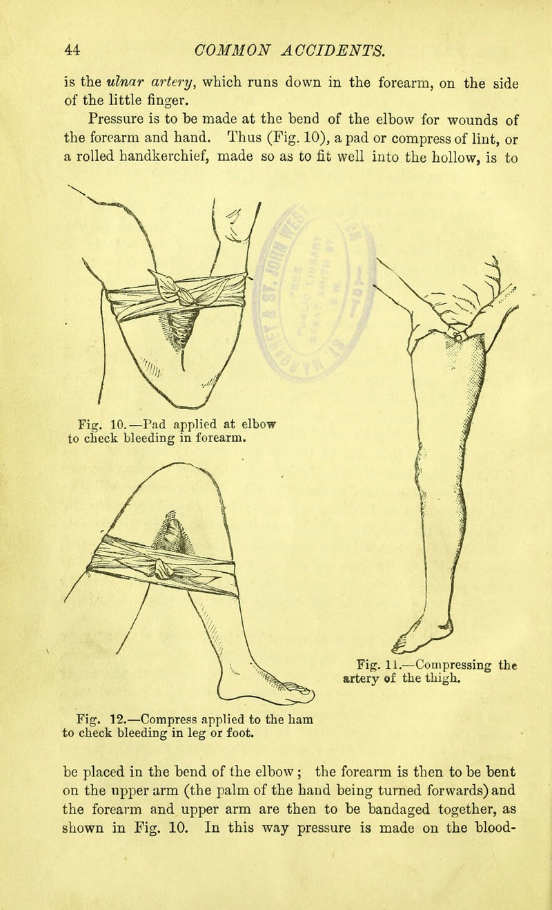 is the ulnar artery, which runs down in the forearm, on the side of the little finger. Pressure is to be made at the bend of the elbow for wounds of the forearm and hand. Thus (Fig. 10), a pad or compress of lint, or a rolled handkerchief, made so as to fit well into the hollow, is to Fig. 12.—Compress applied to the ham to check bleeding in leg or foot. be placed in the bend of the elbow; the forearm is then to be bent on the upper arm (the palm of the hand being turned forwards) and the forearm and upper arm are then to be bandaged together, as shown in Fig. 10. In this way pressure is made on the blood-