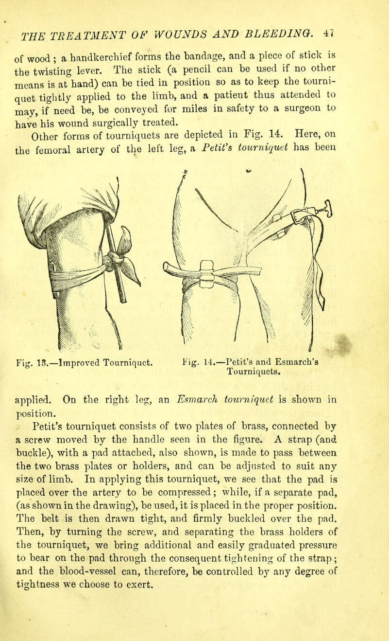 of wood ; a handkerchief forms the bandage, and a piece of stick is the twisting lever. The stick (a pencil can be used if no other means is at hand) can be tied in position so as to keep the tourni- quet tightly applied to the limb, and a patient thus attended to may, if need be, be conveyed for miles in safety to a surgeon to have his wound surgically treated. Other forms of tourniquets are depicted in Fig. 14. Here, on the femoral artery of the left leg, a Petifs tourniqutt has been Fig. 15.—Improved Tourniquet. Fig. 14.—Petit's and Esmarch's Tourniquets. applied. On the right leg, an Eamarch tourniquet is shown in position. Petit's tourniquet consists of two plates of brass, connected by a screw moved by the handle seen in the figure. A strap (and buckle), with a pad attached, also shown, is made to pass between the two brass plates or holders, and can be adjusted to suit any size of limb. In applying this tourniquet, we see that the pad is placed over the artery to be compressed; while, if a separate pad, (as shown in the drawing), be used, it is placed in the proper position. The belt is then drawn tight, and firmly buckled over the pad. Then, by turning the screw, and separating the brass holders of the tourniquet, we bring additional and easily graduated pressure to bear on the pad through the consequent tightening of the strap; and the blood-vessel can, therefore, be controlled by any degree of tightness we choose to exert.