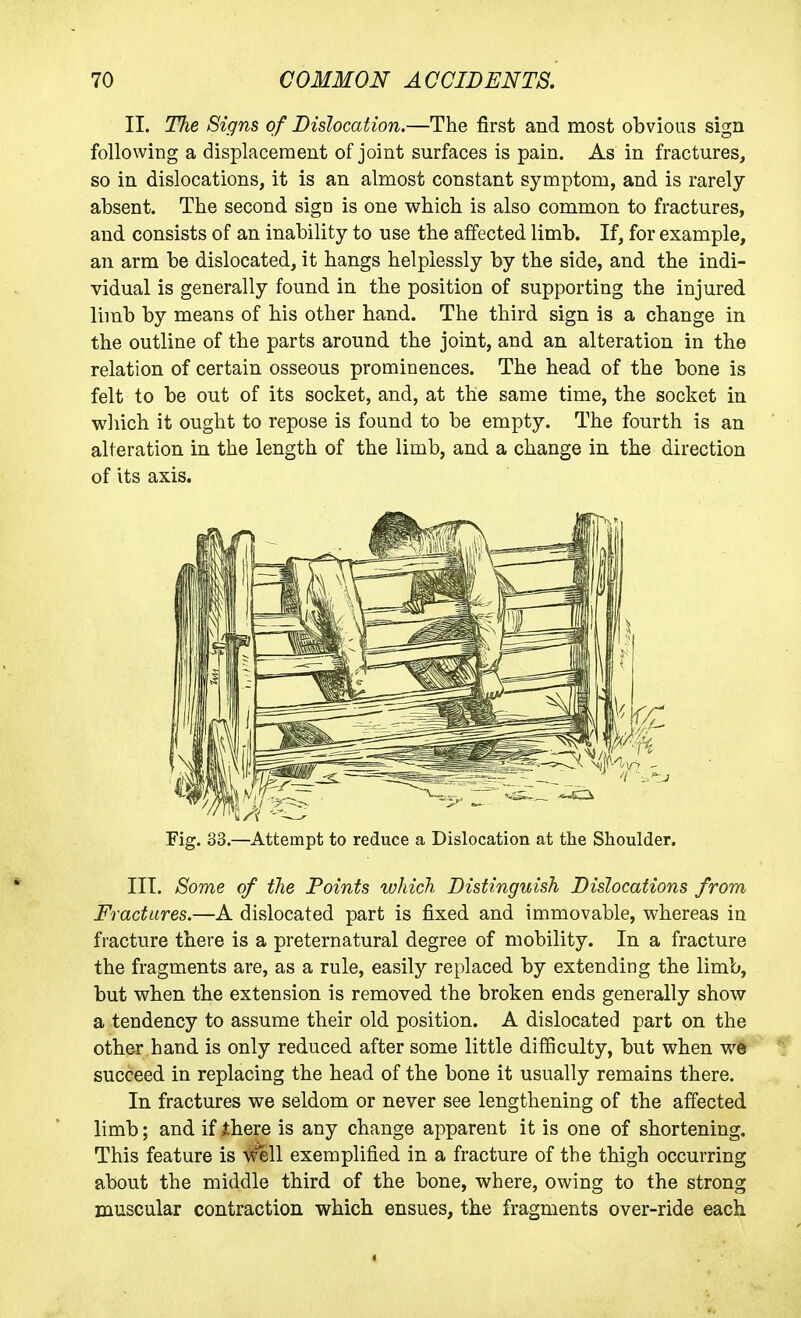 II. The Signs of Dislocation.—The first and most obvious sign following a displacement of joint surfaces is pain. As in fractures, so in dislocations, it is an almost constant symptom, and is rarely absent. The second sign is one which is also common to fractures, and consists of an inability to use the affected limb. If, for example, an arm be dislocated, it hangs helplessly by the side, and the indi- vidual is generally found in the position of supporting the injured limb by means of his other hand. The third sign is a change in the outline of the parts around the joint, and an alteration in the relation of certain osseous prominences. The head of the bone is felt to be out of its socket, and, at the same time, the socket in which it ought to repose is found to be empty. The fourth is an alteration in the length of the limb, and a change in the direction of its axis. Fig. 33.—Attempt to reduce a Dislocation at the Shoulder. III. Some of the Points which Distinguish Dislocations from Fractures.—A dislocated part is fixed and immovable, whereas in fracture there is a preternatural degree of mobility. In a fracture the fragments are, as a rule, easily replaced by extending the limb, but when the extension is removed the broken ends generally show a tendency to assume their old position. A dislocated part on the other hand is only reduced after some little difficulty, but when w#IP succeed in replacing the head of the bone it usually remains there. In fractures we seldom or never see lengthening of the affected limb; and if there is any change apparent it is one of shortening. This feature is w^ll exemplified in a fracture of the thigh occurring about the middle third of the bone, where, owing to the strong muscular contraction which ensues, the fragments over-ride each
