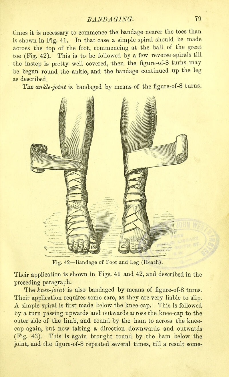 times it is necessary to commence the bandage nearer the toes than is shown in Fig. 41. In that case a simple spiral should be made across the top of the foot, commencing at the ball of the great toe (Fig. 42). This is to be followed by a few reverse spirals till the instep is pretty well covered, then the figure-of-8 turns may be begun round the ankle, and the bandage continued up the leg as described. The anJde-joint is bandaged by means of the figure-of-8 turns. Fig. 42—Bandage of Foot and Leg (Heath). Their application is shown in Figs. 41 and 42, and described in the preceding paragraph. The knee-joint is also bandaged by means of figure-of-8 turns. Their application requires some care, as they are very liable to slip. A simple spiral is first made below the knee-cap. This is followed by a turn passing upwards and outwards across the knee-cap to the outer side of the limb, and round by the ham to across the knee- cap again, but now taking a direction downwards and outwards (Fig. 43). This is again brought round by the ham below the joint, and the figure-of-8 repeated several times, till a result some-
