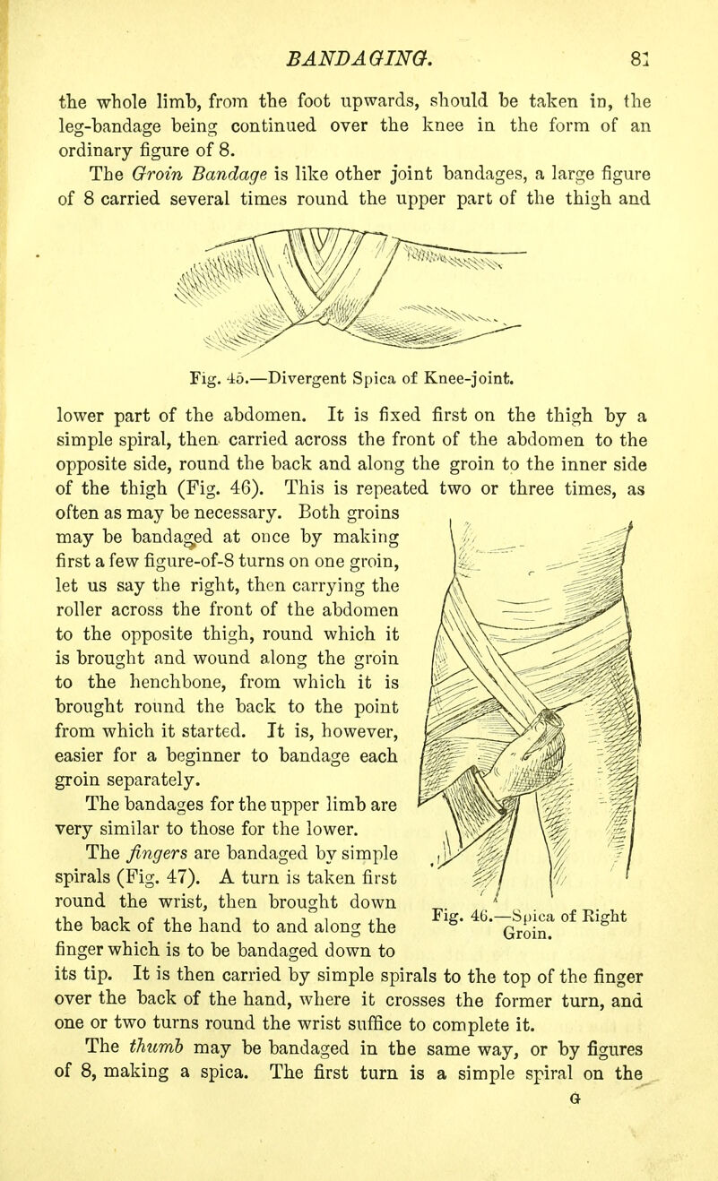 tlie whole limb, from the foot upwards, should be taken in, the leg-bandage being continued over the knee in the form of an ordinary figure of 8. The Groin Bandage is like other joint bandages, a large figure of 8 carried several times round the upper part of the thigh and Fig. 46.—Divergent Spica of Knee-joint. lower part of the abdomen. It is fixed first on the thigh by a simple spiral, then carried across the front of the abdomen to the opposite side, round the back and along the groin to the inner side of the thigh (Fig. 46). This is repeated two or three times, as often as may be necessary. Both groins may be bandaged at once by making first a few figure-of-8 turns on one groin, let us say the right, then carrying the roller across the front of the abdomen to the opposite thigh, round which it is brought and wound along the groin to the henchbone, from which it is brought round the back to the point from which it started. It is, however, easier for a beginner to bandage each groin separately. The bandages for the upper limb are very similar to those for the lower. The fingers are bandaged by simple spirals (Fig. 47). A turn is taken first round the wrist, then brought down the back of the hand to and along the finger which is to be bandaged down to its tip. It is then carried by simple spirals to the top of the finger over the back of the hand, where it crosses the former turn, and one or two turns round the wrist suffice to complete it. The thumb may be bandaged in the same way, or by figures of 8, making a spica. The first turn is a simple spiral on the G Fig. 46.—Spica of Right Groin.