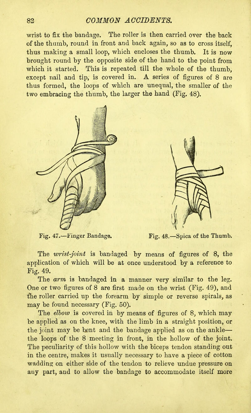 wrist to fix the bandage. The roller is then carried over the back of the thumb, round in front and back again, so as to cross itself, thus making a small loop, which encloses the thumb. It is now brought round by the opposite side of the hand to the point from which it started. This is repeated till the whole of the thumb, except nail and tip, is covered in. A series of figures of 8 are thus formed, the loops of which are unequal, the smaller of the two embracing the thumb, the larger the hand (Fig. 48). Fig. 47.—Finger Bandage. Fig. 48.—Spica of the Thumb. The wrist-joint is bandaged by means of figures of 8, the application of which will be at once understood by a reference to Fig. 49. The arm is bandaged in a manner very similar to the leg. One or two figures of 8 are first made on the wrist (Fig. 49), and tlie roller carried up the forearm by simple or reverse spirals, as may be found necessary (Fig. 50). The elbow is covered in by means of figures of 8, which may be applied as on the knee, with the limb in a straight position, or the joint may be bent and the bandage applied as on the ankle— the loops of the 8 meeting in front, in the hollow of the joint. The peculiarity of this hollow with the biceps tendon standing out in the centre, makes it usually necessary to have a piece of cotton waddino; on either side of the tendon to relieve undue pressure on any part, and to allow the bandage to accommodate itself more