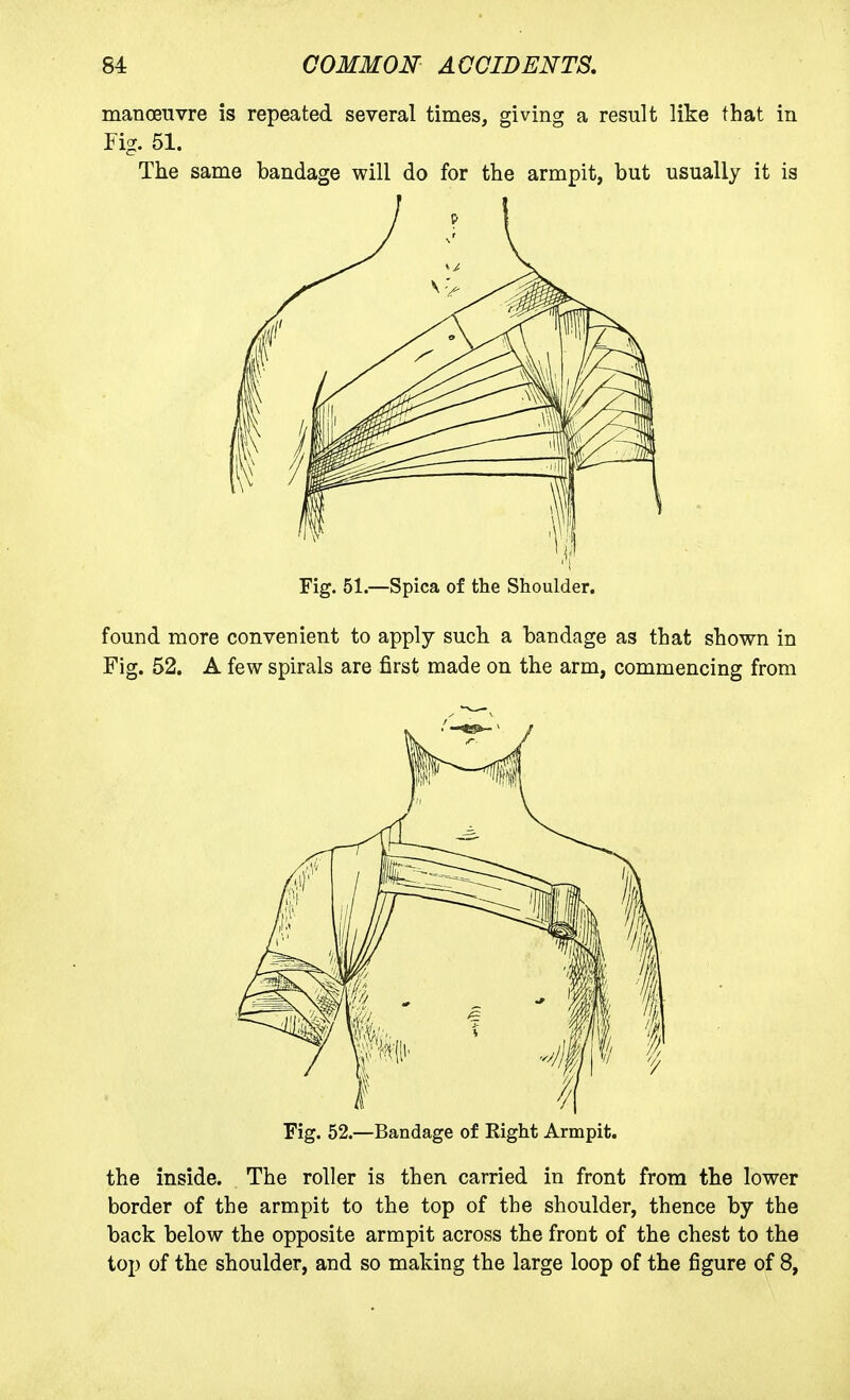 manoeuvre is repeated several times, giving a result like that in Fig. 51. The same bandage will do for the armpit, but usually it is Fig. 51.—Spica of the Shoulder. found more convenient to apply such a bandage as that shown in Fig. 52. A few spirals are first made on the arm, commencing from Fig. 52.—Bandage of Right Armpit. the inside. The roller is then carried in front from the lower border of the armpit to the top of the shoulder, thence by the back below the opposite armpit across the front of the chest to the top of the shoulder, and so making the large loop of the figure of 8,