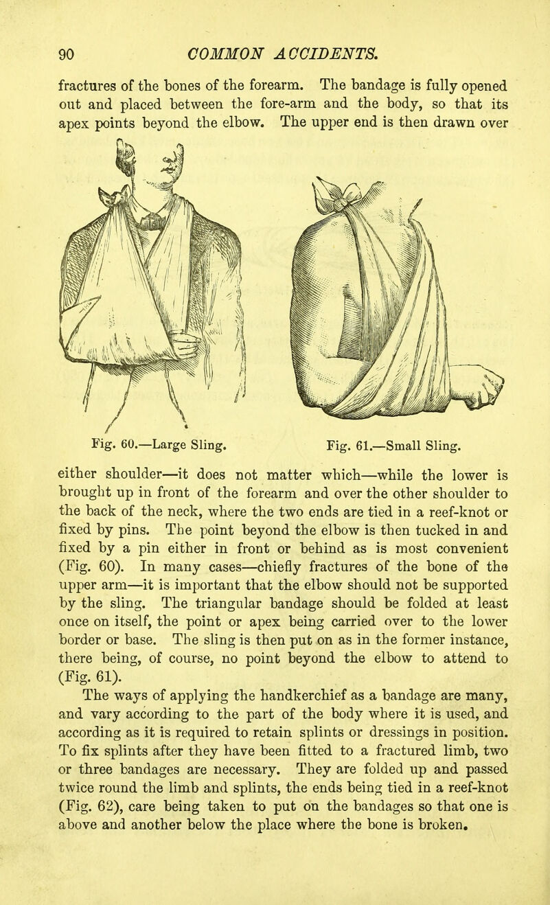 fractures of the bones of the forearm. The bandage is fully opened out and placed between the fore-arm and the body, so that its apex points beyond the elbow. The upper end is then drawn over Fig. 60.—Large Sling. Fig. 61.—Small Sling. either shoulder—it does not matter which—while the lower is brought up in front of the forearm and over the other shoulder to the back of the neck, where the two ends are tied in a reef-knot or fixed by pins. The point beyond the elbow is then tucked in and fixed by a pin either in front or behind as is most convenient (Fig. 60). In many cases—chiefly fractures of the bone of the upper arm—it is important that the elbow should not be supported by the sling. The triangular bandage should be folded at least once on itself, the point or apex being carried over to the lower border or base. The sling is then put on as in the former instance, there being, of course, no point beyond the elbow to attend to (Fig. 61). The ways of applying the handkerchief as a bandage are many, and vary according to the part of the body where it is used, and according as it is required to retain splints or dressings in position. To fix splints after they have been fitted to a fractured limb, two or three bandages are necessary. They are folded up and passed twice round the limb and splints, the ends being tied in a reef-knot (Fig. 62), care being taken to put on the bandages so that one is above and another below the place where the bone is broken.