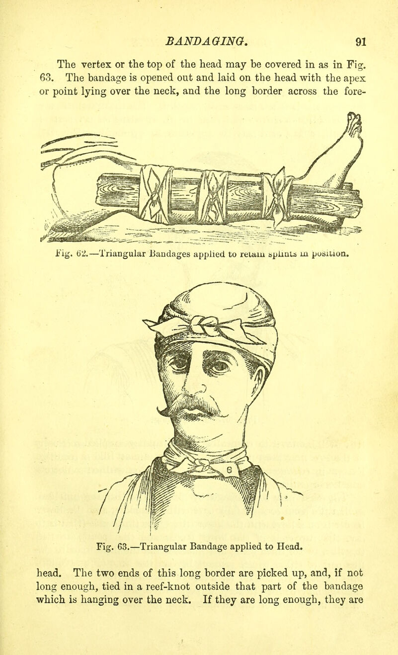 The vertex or the top of the head may be covered in as in Fig. 63. The bandage is opened out and laid on the head with the apex or point lying over the neck, and the long border across the fore- Fig. 63.—Triangular Bandage applied to Head. head. The two ends of this long border are picked up, and, if not long enough, tied in a reef-knot outside that part of the bandage which is hanging over the neck. If they are long enough, they are
