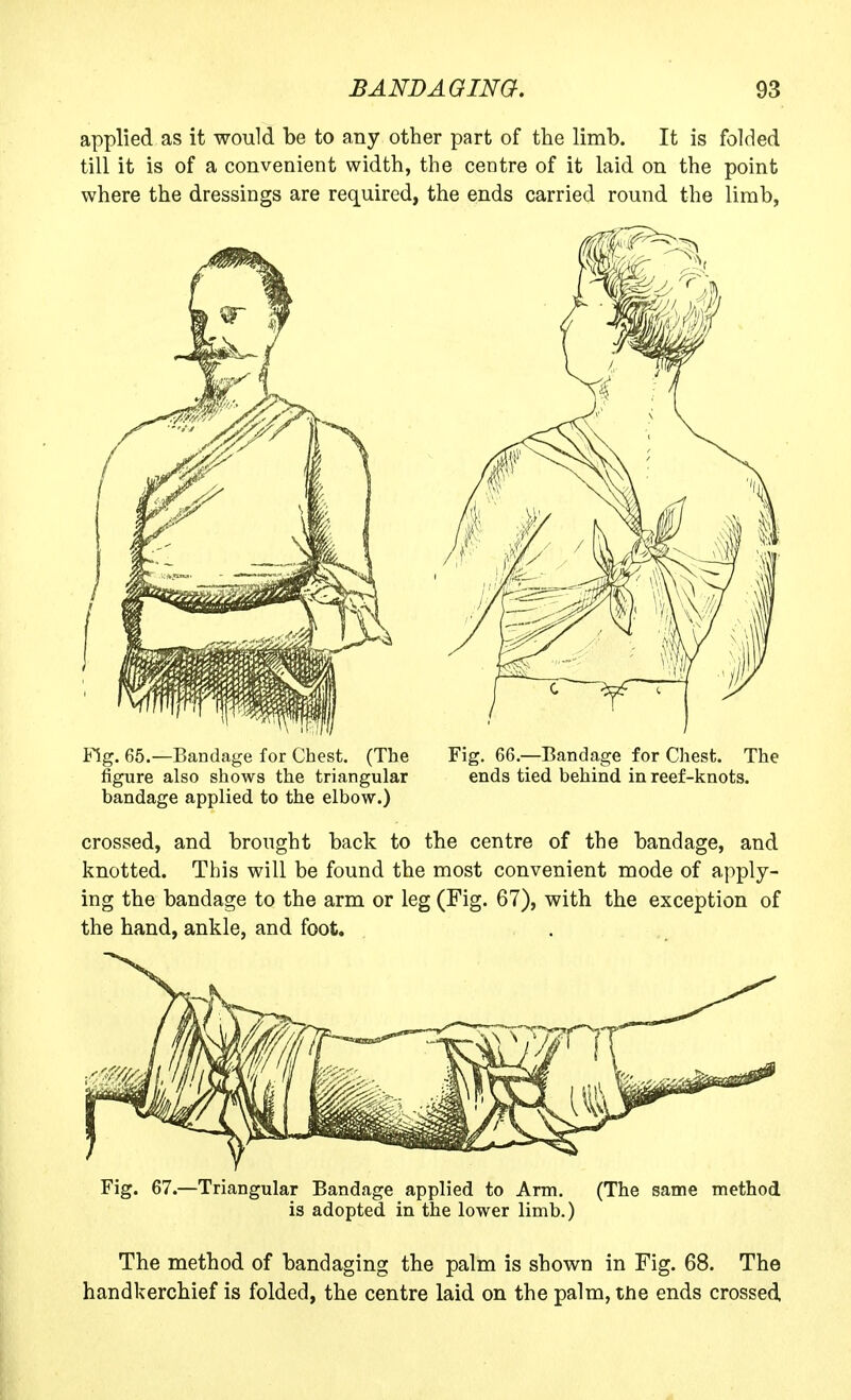 applied as it would be to any other part of the limb. It is folded till it is of a convenient width, the centre of it laid on the point where the dressings are required, the ends carried round the limb, Fig. 65.—Bandage for Chest. (The Fig. 66.—Bandage for Chest. The figure also shows the triangular ends tied behind in reef-knots, bandage applied to the elbow.) crossed, and brought back to the centre of the bandage, and knotted. This will be found the most convenient mode of apply- ing the bandage to the arm or leg (Fig. 67), with the exception of the hand, ankle, and foot. Fig. 67.—Triangular Bandage applied to Arm. (The same method is adopted in the lower limb.) The method of bandaging the palm is shown in Fig. 68. The handkerchief is folded, the centre laid on the palm, the ends crossed
