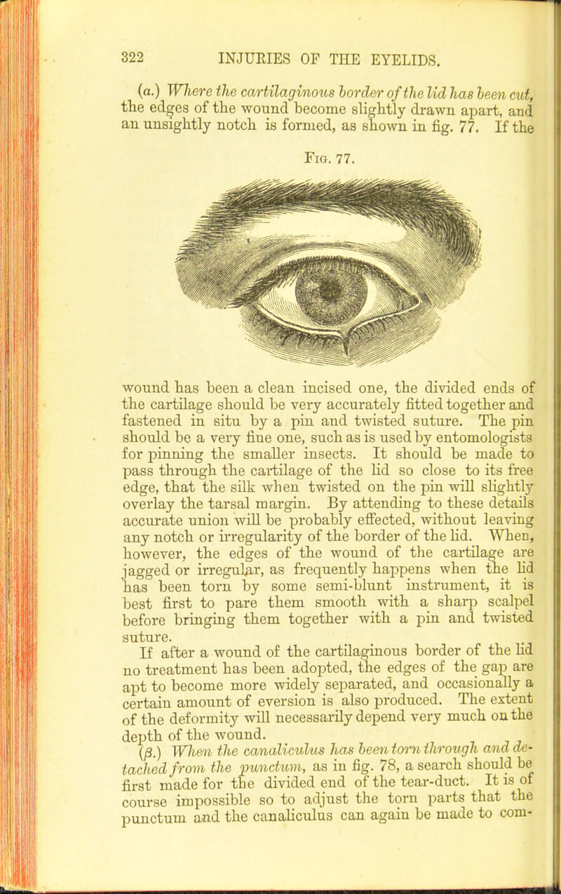 (a.) Where the cartilaginous harder of the lid has been cut, th.Q edges of tlie wound become sliglitly drawn apart, and an unsightly notch, is formed, as shown in fig, 77. If the Fig. 77. wound has been a clean incised one, the divided ends of the cartilage should be very accurately fitted together and fastened in situ by a pin and twisted suture. The pin should be a very fine one, such as is used by entomologists for pinning the smaller insects. It should be made to pass through the cartilage of the Ud so close to its free edge, that the silk when twisted on the pin will slightly overlay the tarsal margin. By attending to these details accurate union wiU be probably efi'ected, without leaving any notch or irregularity of the border of the Hd. When, however, the edges of the wound of the cartilage are jagged or irregnlKr, as frequently happens when the lid has been torn by some semi-blunt instrument, it is best first to pare them smooth with a sharp scalpel before bringing them together with a pin and twisted suture. If after a wound of the cartilaginous border of the Hd no treatment has been adopted, the edges of the gap are apt to become more widely separated, and occasionally a certain amount of eversion is also produced. The extent of the deformity will necessarily depend very much on the depth of the wound. {§.) Wlien the canaliculus has bee^i torn through ana de- tached from the punctum, as in fig. 78, a search should be first made for the divided end of the tear-duct. It is of course impossible so to adjust the torn parts that the punctum and the canaliculus can again be made to com-