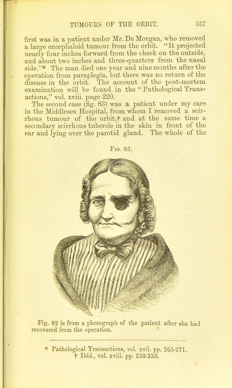 first was in a patient under Mr. De Morgan, wlio removed a large enceplialoid tumour from tlie orbit. It projected nearly four inches forward from the cheek on the outside, and about two inches and three-quarters from the nasal side.* The man died one year and nine months after the operation from paraplegia, but there was no return of the disease in the orbit. The account of the post-mortem examination will be found in the Pathological Trans- actions, vol. xviii. page 220. The second case (fig. 83) was a patient under my care in the Middlesex Hospital, from whom I removed a scir- rhous tumour of the orbit,t and at the same time a secondary scirrhous tubercle in the skin in front of the ear and lying over the parotid gland. The whole of the Fig. 83. Fig. 82 is from a photograph of the patient after she had recovered from the operation. * * Pathological Transactions, vol. xvii. pp. 265-271. t Ibid., vol. xviii. pp. 233-235.