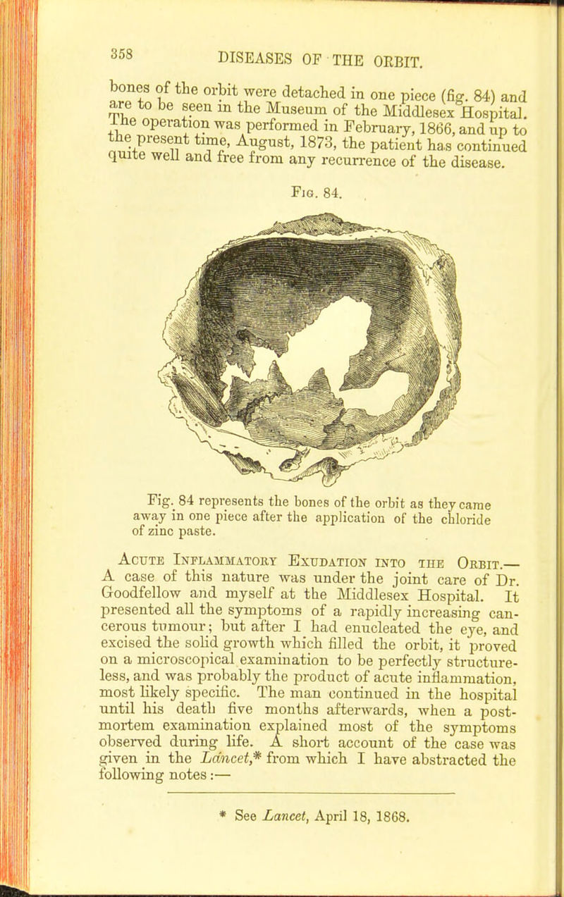 bones of the orbit were detached in one piece (fig. 84) and are to be seen m the Museum of the Middlesex Hospital, liie operation was performed in February, 1866, and up to the present time, August, 1873, the patient ha.s continued quite well and free from any recurrence of the disease. Fig. 84. Fig._84 represents the bones of the orbit as they came away in one piece after the application of the chloride of zinc paste. Acute Inflammatoky Exudation into the Orbit. A case of this nature was under the joint care of Dr. Goodfellow and myself at the Middlesex Hospital. It presented all the symptoms of a rapidly increasing can- cerous tumour ; but after I had enucleated the eye, and excised the solid growth which filled the orbit, it proved on a microscopical examination to be perfectly structure- less, and was probably the product of acute inflammation, most likely specific. The man continued in the hospital until his death five months afterwards, when a post- mortem examination explained most of the symptoms obsei-ved during life. A short account of the case was given in the Lancet* from which I have abstracted the following notes:— * See Lancet, April 18, 1868.