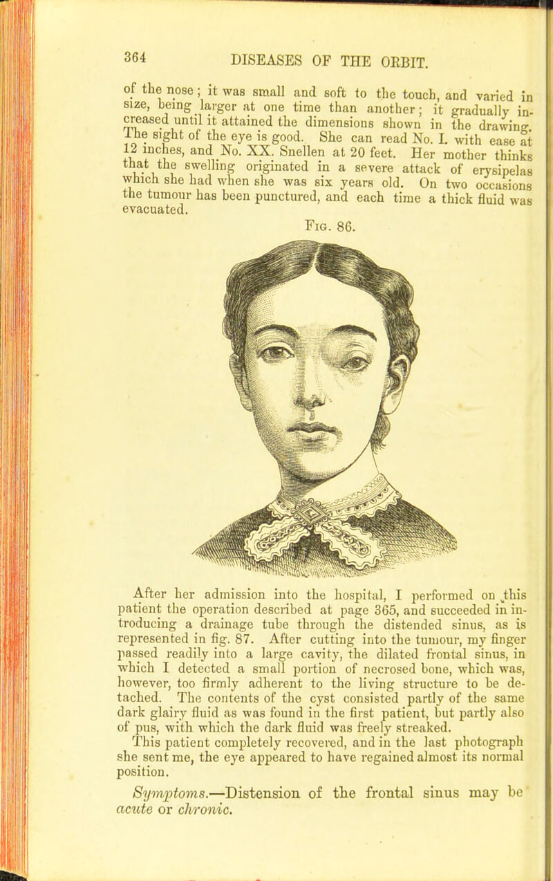 of the nose; it was small and soft to the touch, and varied in size, being larger at one time than another; it gradually in- creased until it attained the dimensions shown in the drawing Ihe sight of the eye is good. She can read No. L with ease at 12 inches, and No. XX. Snellen at 20 feet. Her mother thinks that the swelhng originated in a severe attack of erysipelas which she had when she was six years old. On two occasions the tumour has been punctured, and each time a thick fluid was evacuated. Fig. 86. After her admission into the hospital, I performed on J;his patient the operation described at page 365, and succeeded in in- troducing a drainage tube through the distended sinus, as is represented in fig. 87. After cutting into the tumour, my finger passed readily into a large cavity, the dilated frontal sinus, in which I detected a small portion of necrosed bone, which was, however, too firmly adherent to the living structure to be de- tached. The contents of the cyst consisted partly of the same dark glairy fluid as was found in the first patient, but partly also of pus, with which the dark fluid was freely streaked. This patient completely recovered, and in the last photograph she sent me, the eye appeared to have regained almost its normal position. Symjotoms.—Distension of the frontal sinus may be acute or chronic.