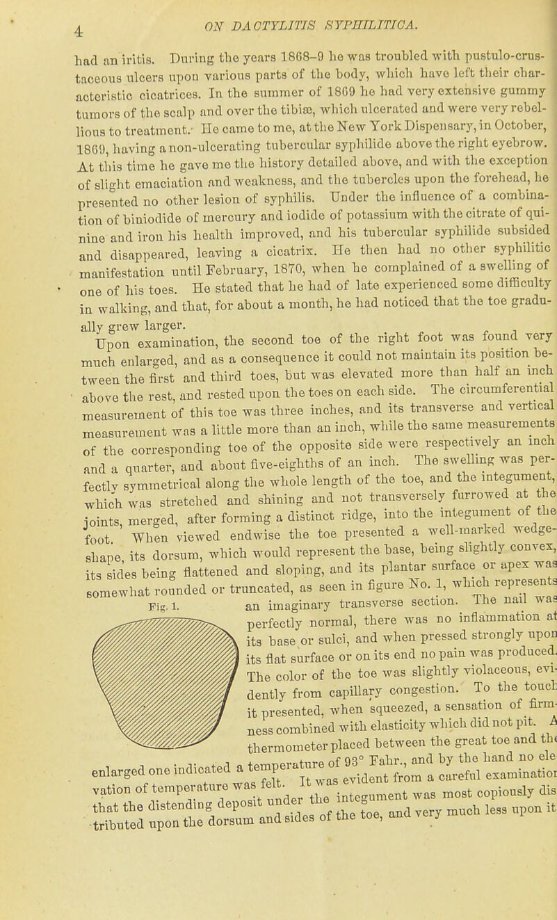 had an iritis. During tlie years 18G8-9 lie was troubled with pustulo-crus- taceous ulcers upon various parts of the body, which have left tlieir char- acteristic cicatrices. In the summer of 18G9 he had very extensive gummy tumors of the scalp and over the tibia;, which ulcerated and were very rebel- lious to treatment.- He came to mo, at the New York Dispensary, in October, 186!), having anon-ulcerating tubercular syphilide above the right eyebrow. At this time he gave me the history detailed above, and with the exception of slight emaciation and weakness, and the tubercles upon the forehead, he presented no other lesion of syphilis. Under the influence of a combina- tion of biniodide of mercury and iodide of potassium with the citrate of qui- nine and iron his health improved, and his tubercular syphilide subsided and disappeared, leaving a cicatrix. He then had no other syphilitic manifestation until February, 1870, when he complained of a swelhng of one of his toes. He stated that he had of late experienced some difficulty in walking, and that, for about a month, he had noticed that the toe gradu- ally grew larger. Upon examination, the second toe of the right foot was found very much enlarged, and as a consequence it could not maintain its position be- tween the first and third toes, but was elevated more than half an inch • above the rest, and rested upon the toes on each side. The circumferentia measurement of this toe was three inches, and its transverse and vertical measurement was a little more than an inch, while the same measurements of the corresponding toe of the opposite side were respectively an inch and a quarter, and about five-eighths of an inch. The swelling was per- fects symmetrical along the whole length of the toe, and the integument, which was stretched and shining and not transversely furrowed at the joints, merged, after forming a distinct ridge, into the integument of the foot When viewed endwise the toe presented a well-marked wedge- shape its dorsum, which would represent the base, being slightly convex, its sides being flattened and sloping, and its plantar surface or apex was somewhat rounded or truncated, as seen in figure No. 1, which represen s Fig. 1. an imaginary transverse section. The nail was perfectly normal, there was no inflammation a1 its base or sulci, and when pressed strongly upon its flat surface or on its end no pain was produced, The color of the toe was slightly violaceous, evi- dently from capillary congestion. To the toucl it presented, when squeezed, a sensation of firm- ness combined with elasticity which did not pit h thermometer placed between the great toe and th. vation of tempe,;*re ^l'* j'™i„7 „„,t co„io»sl, dis