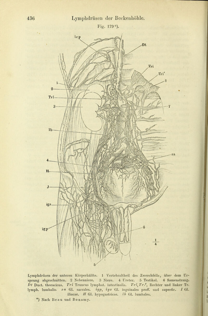 Fig. 179*). Lymphdrüsen der unteren Körperhälfte. 1 Vertebraltheil des Zwerchfells, über dem Ur- sprung abgeschnitten. 2 Nebenniere. 3 Niere. 4 Ureter. 5 Testikel. 6 Samenstrang. Dt Duct. thoracicus. Tr-i Truncus lymphat. intestinalis. Trl^TrJ^ Rechter und linker Tr. lymph. lumbalis. sa Gl. sacrales. ^gV-, igs Gl. inguinales proft'. uiid superfic. / Gl. iliacae. II Gl. hypogastricae. Ib Gl. lumbales. *) Nach Beau und Bonamy.