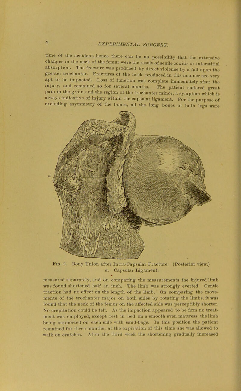 EXPERIMENTAL SURGERY. time of the accident, hence there can be no possibility that the extensive changes in the neck of the femur were the result of senUe coxitis or interstitial absorption. The fracture was produced by direct violence by a fall upon the greater trochanter. Fractures of the neck produced in this manner are very apt to be impacted. Loss of function was complete immediately after the injury, and remained so for several months. The patient suffered great pain in the groin and the region of the trochanter minor, a symptom which is always indicative of injury within the capsular ligament. For the purpose of excluding asymmetry of the bones, all the long bones of both legs were Fig. 2. Bony Uuiou after lutra-OajJsular Fracture. (Posterior view.) a. Capsular Ligament. ■ measured separately, and on comparing the measurements the injured limb was found shortened half an inch. The limb was strongly everted. Gentle traction had no effect on the length of the limb. On comparing the move- ments of the trochanter major on both sides by rotating the limbs, it was found that the neck of the femur on the affected side was perceptibly shorter. No crepitation could be folt. As the impaction appeared to be firm no treat- ment was employed, except rest in bed on a smooth even mattress, the limb being supported on each side with sand-bags. In this position the patient remained for three months; at the expiration of this time she was allowed to walk on crutches. After the third week the shortening gradually increased