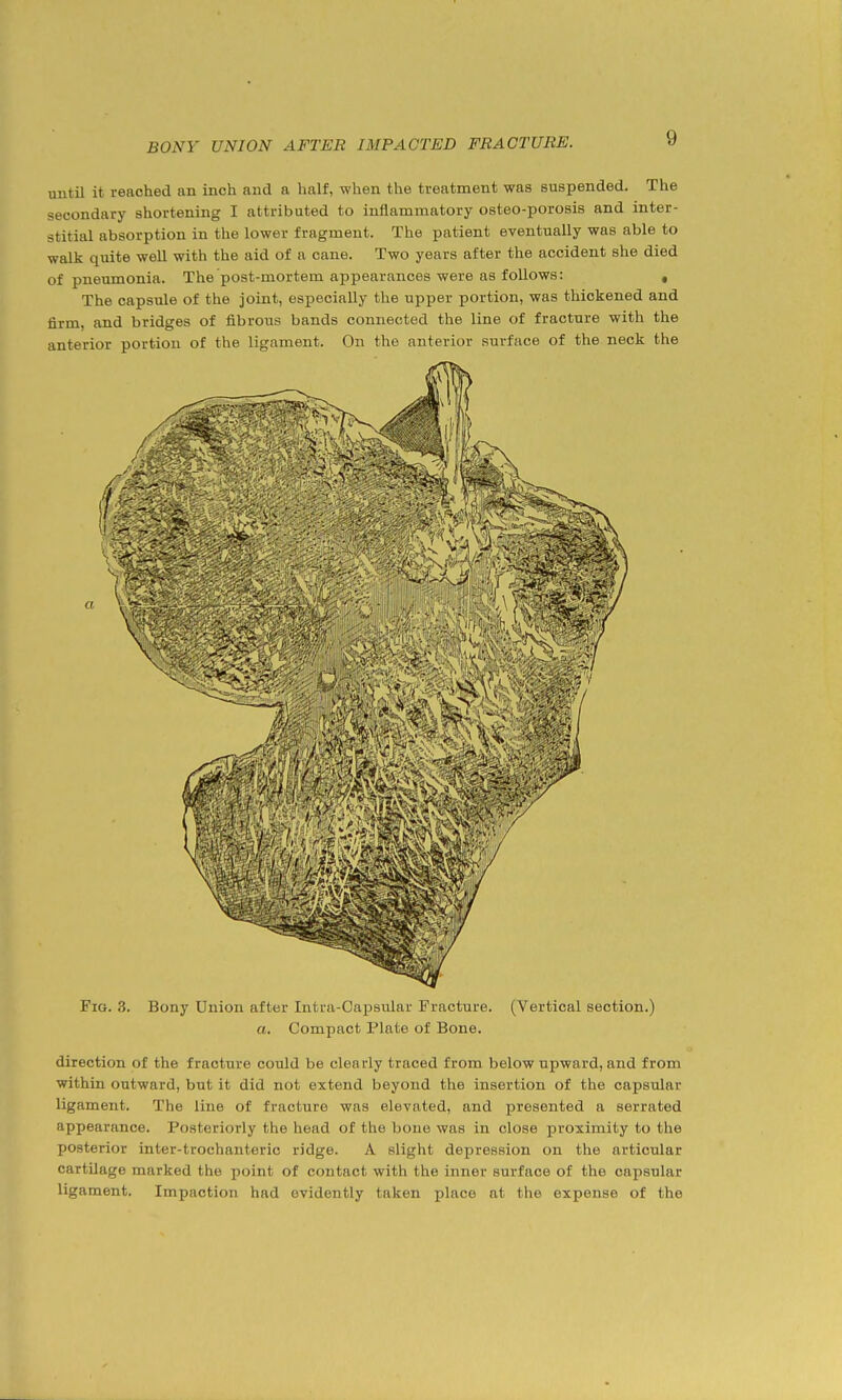 until it reached an inch and a half, when the treatment was suspended. The secondary shortening I attributed to inflammatory osteo-porosis and inter- stitial absorption in the lower fragment. The patient eventually was able to walk quite well with the aid of a cane. Two years after the accident she died of pneumonia. The post-mortem appearances were as follows: , The capsule of the joint, especially the upper portion, was thickened and firm, and bridges of fibrous bands connected the line of fracture with the anterior portion of the ligament. On the anterior surface of the neck the Fig. 3. Bony Union after Intra-Capsular Fracture. (Vertical section.) a. Compact Plate of Bone. direction of the fracture could be clearly traced from below upward, and from within outward, but it did not extend beyond the insertion of the capsular ligament. The line of fracture was elevated, and presented a serrated appearance. Posteriorly the head of the bone was in close proximity to the posterior inter-trochanteric ridge. A slight depression on the articular cartilage marked the point of contact with the inner surface of the cajjsular ligament. Impaction had evidently taken place at the expense of the