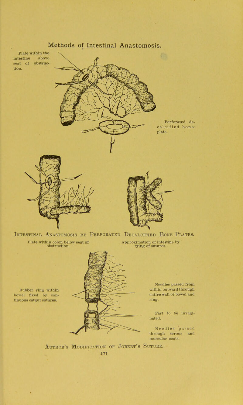 Methods of Intestinal Anastomosis. Plate ■within the intestine above seat of obstruc- tion. Perforated de- calcified bone- plate. luTESTiNAii Anastomosis by Pekforated Decalcified Bone-Plates. Plate within colon below seat of obstruction. Approximation of intestine by tying of sutures. Rubber ring within bowel fixed by con- tinuous catgut sutures. Needles passed from within outward through entire wall of bowel and ring. Part to be invagi- nated. Needles passed through serous and muscular coats. Author's Modification of Jobert's Suture.