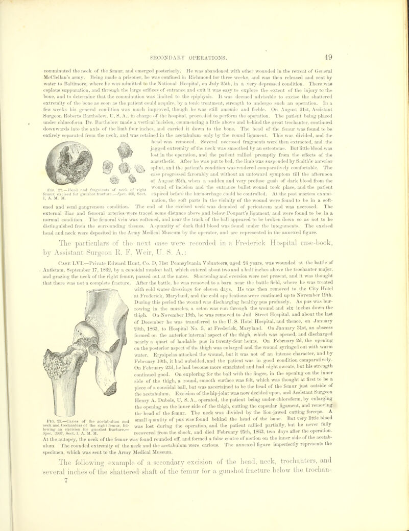 comminuted the neck of the femur, and emerged posteriorly. He was abandoned with other wounded in the retreat of General McClellan's army. Being made a prisoner, lie was confined in Richmond tor three weeks, and was then released and sent by water to Baltimore, where he was admitted to the National Hospital, on July 25th, in a very depressed condition. There was copious suppuration, and through the large orifices of entrance and exit it was easy to explore the extent of the injury to the bone, and to determine that the comminution was limited to the epiphysis. It was deemed advisable to excise the shattered extremity of the bone as soon as the patient could acquire, by a tonic treatment, strength to undergo such an operation. In a few weeks his general condition was much improved, though he was still anaemic and feeble. On August 21st, Assistant Surgeon Roberts Bartholow, U. S. A., in charge of the hospital, proceeded to perform the operation. The patient being placed under chloroform, Dr. Bartholow made a vertical incision, commencing a little above and behind the great trochanter, continued downwards into the axis of the limb four inches, and carried it down to the bone. The head of the femur was found to be entirely separated from the neck, and was retained in the acetabulum only by the round ligament. This was divided, and the head was removed. Several necrosed fragments were then extracted, and the jagged extremity of the neck was smoothed by an osteotome. But little blood was lost in the operation, and the patient rallied promptly from the effects of the anaesthetic. After he was put to bed, the limb was suspended by Smith's anterior splint, and the patient's condition was rendered comparatively comfortable. The case progressed favorably and without an untoward symptom till the afternoon of August 25th, when a sudden and very profuse gusli of dark blood from the wound of incision and the entrance bullet wound took place, and the patient expired before the haemorrhage could be controlled. At the post mortem exami- nation, the soft parts in the vicinity of the wound were found to be in a soft- ened and semi gangrenous condition. The end of the excised neck was denuded of periosteum and was necrosed. The external iliac and femoral arteries were traced some distance above and below Poupart's ligament, and were found to be in a normal condition. The femoral vein was softened, and near the track of the ball appeared to be broken down so as not to be distinguished from the surrounding tissues. A quantity of dark fluid blood was found under the integuments. The excised head and neck were deposited in the Army Medical Museum by the operator, and are represented in the annexed figure. The particulars of the next case were recorded in a Frederick Hospital case-book, by Assistant Surgeon R. F. Weir, U. S. A.: Case LVI.—Private Edward Hunt, Co. D, 71st Pennsylvania Volunteers, aged 24 years, was wounded at the battle of Antietam, September 17, 1862, by a conoidal musket ball, which entered about two and a half inches above the trochanter major, and grazing the neck of the right femur, passed out at the nates. Shortening and eversion were not present, and it was thought Flo. 2*2.—Head and fragments of neck of rig-lit femur, excised for gunshot fracture.—Spec. 401), .Sect. 1, A. M. M. that there was not a complete fracture. After the battle, he was removed to a barn near the battle field, where he was treated with cold water dressings for eleven days. He was then removed to the City Hotel at Frederick, Maryland, and the cold applications were continued up to November 19th. During this period the wound was discharging healthy pus profusely. As pus was bur- rowing in the muscles, a seton was run through the wound and six inches down the thigh. On November 19th, he was removed to Jail Street Hospital, and about the last of December he was transferred to the IT. S. Hotel Hospital, and thence, on January 20th, 1863, to Hospital No. 5, at Frederick, Maryland. On January 31st, an abscess formed on the anterior internal aspect of the thigh, which was opened, and discharged nearly a quart of laudable pus in twenty-four hours. On February 2d, the opening on the posterior aspect of the thigh was enlarged and the wound syringed out with warm water. Erysipelas attacked the wound, but it was not of an intense character, and by February 10th, it had subsided, and the patient was in good condition comparatively. On February 23d, he had become more emaciated and had night sweats, but his strength continued good. On exploring for the ball with the finger, in the opening on the inner side of the thigh, a round, smooth surface was felt, which was thought at first to be a piece of a conoidal ball, but was ascertained to be the head of the femur just outside of the acetabulum. Excision of the hip-joint was now decided upon, and Assistant Surgeon Henry A. Dubois, U. S. A., operated, the patient being under chloroform, by enlarging the opening on the inner side of the thigh, cutting the capsular ligament, and removing the head of the femur. The neck was divided by the lion-jawed cutting forceps. A small quantity of pus was found behind the head of the bone. But very little blood was lost during the operation, and the patient rallied partially, but he never fully .Spec.'3907, Sect, l, A. M. M. recovered from the shock, and died February 25th, 1863, two days after the operation. At the autopsy, the neck of the femur was found rounded oft', and formed a false centre of motion on the inner side of the acetab- ulum. The rounded extremity of the neck and the acetabulum were carious. The annexed figure imperfectly represents the specimen, which was sent to the Army Medical Museum. FIG. 23.—Caries of the acetabulum and neck and trochanters of the right femur, fol- lowing an excision for gunshot fracture.— The following example of a secondary excision of the head, neck, trochanters, and several inches of the shattered shaft of the femur for a gunshot fracture below the trochan- 7