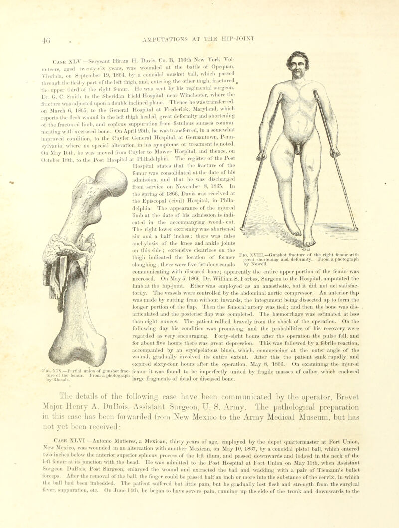 Case XLV.—Sergeant Hiram H. Davis, Co. B, 156th New York Vol- unteers, aged twenty-six years, was wounded at the battle of Opequan, Virginia, on September 19, 1864, by a conoidal musket ball, which passed through the fleshy part of the left thigh, and, entering the other thigh, fractured . the upper third of the right femur. He was sent by his regimental surgeon, Dr. (i. C. Smith, to the Sheridan Field Hospital, near Winchester, where the fracture was adjusted upon a double inclined plane. Thence he was transferred, on March 6, 1865, to the General Hospital at Frederick, Maryland, which reports the flesh wound in the left thigh healed, great deformity and shortening of the fractured limb, and copious suppuration from fistulous sinuses commu- nicating with necrosed bone. On April 25th, he was transferred, in a somewhat improved condition, to the Cuyler General Hospital, at Germantowti, Penn- sylvania, where no special alteration in bis symptoms or treatment is noted. On May 10th, he was moved from Cuyler to Mower Hospital, and thence, on October 18th, to the Post Hospital at Philadelphia. The register of the Post Hospital states that the fracture of the femur was consolidated at the date of bis admission, and that he was discharged from service on November 8, 1865. In the spring of 1866, Davis was received at the Episcopal (civil) Hospital, in Phila- delphia. The appearance of the injured limb at the date of bis admission is indi- cated in the accompanying wood - cut. Tlie right lower extremity was shortened six and a half inches; there was false anchylosis of the knee and ankle joints on this side; extensive cicatrices on the thigh indicated the location of former sloughing; there were five fistulous canals communicating with diseased bone; apparently the entire upper portion of the femur was necrosed. On May 5, 1866, Dr. William S. Forbes, Surgeon to the Hospital, amputated the limb at the hip-joint. Ether was employed as an anaesthetic, but it did not act satisfac- torily. The vessels were controlled by the abdominal aortic compressor. An anterior flap was made by cutting from without inwards, the integument being dissected up to form the longer portion of the flap. Then the femoral artery was tied; and then the bone was dis- articulated and the posterior flap was completed. The haemorrhage was estimated at less than eight ounces. The patient rallied bravely from the shock of the operation. On the following day his condition was promising, and the probabilities of his recovery were regarded as very encouraging. Forty-eight hours after the operation the pulse fell, and for about five hours there was great depression. This was followed by a febrile reaction, accompanied by an erysipelatous blush, which, commencing at the outer angle of the wound, gradually involved its entire extent. After this the patient sank rapidly, and expired sixty-four hours after the operation, May 8, 1866. On examining the injured Fig. XIX.—Partial union of gunshot frac- femur it was found to be imperfectly united by fragile masses of callus, which enclosed tare of (he femur. From a photograph „ „ , , ,. _ by Rhoads. large fragments of dead or diseased bone. Fig. XVIII.—Gunshot fracture of the right femur with great shortening and deformity. From a photograph by Newell. The details of the following case have been communicated by the operator, Brevet Major Eenry A. DuBois, Assistant Surgeon, U. S. Army. The pathological preparation in this case has been forwarded from New Mexico to the Army Medical Museum, but has not yet been received: Cask XLVI.—Antonio Mutieres, a Mexican, thirty years of age, employed by the depot quartermaster at Fort Union, New Mexico, was wounded in an altercation with another Mexican, on May 10, 1867, by a conoidal pistol ball, which entered two inches below the anterior superior spinous process of the left ilium, and passed downwards and lodged in the neck of the left femur at its junction with the head. He was admitted to the Post Hospital at Fort Union on May 11th, when Assistant Surgeon DuBois, Post Surgeon, enlarged the wound and extracted the ball and wadding with a pair of Tiemann's bullet forceps. After the removal of the ball, the finger could be passed half an inch or more into the substance of the cervix, in which the ball had been imbedded. The patient suffered but little pain, but be gradually lost flesh and strength from the surgical lever, suppuration, etc. On June 14th, he began to have severe pain, running up the side of the trunk and downwards to the