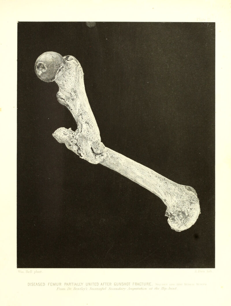 DISEASED FEMUR PARTIALLY UNITED AFTER GUNSHOT FRACTURE. Skcimkx Amor mkdjtai Mvsr.m from- Dr. fientlrv's Srurrss/ir/ Serondtiry Ar/iprtttttiort <il the Hip-Joint.
